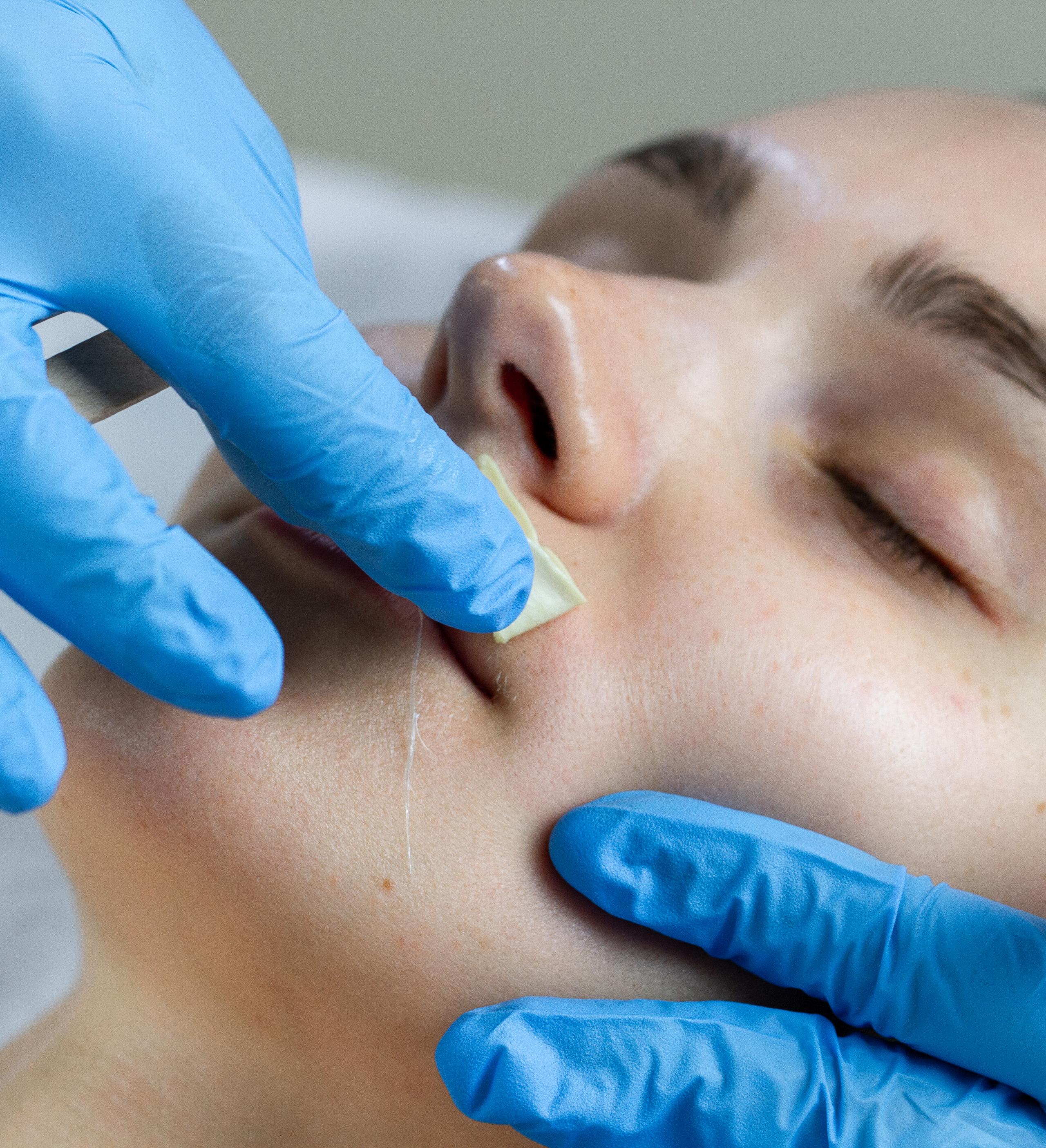 Woman getting upper lip waxed by gloved hands.