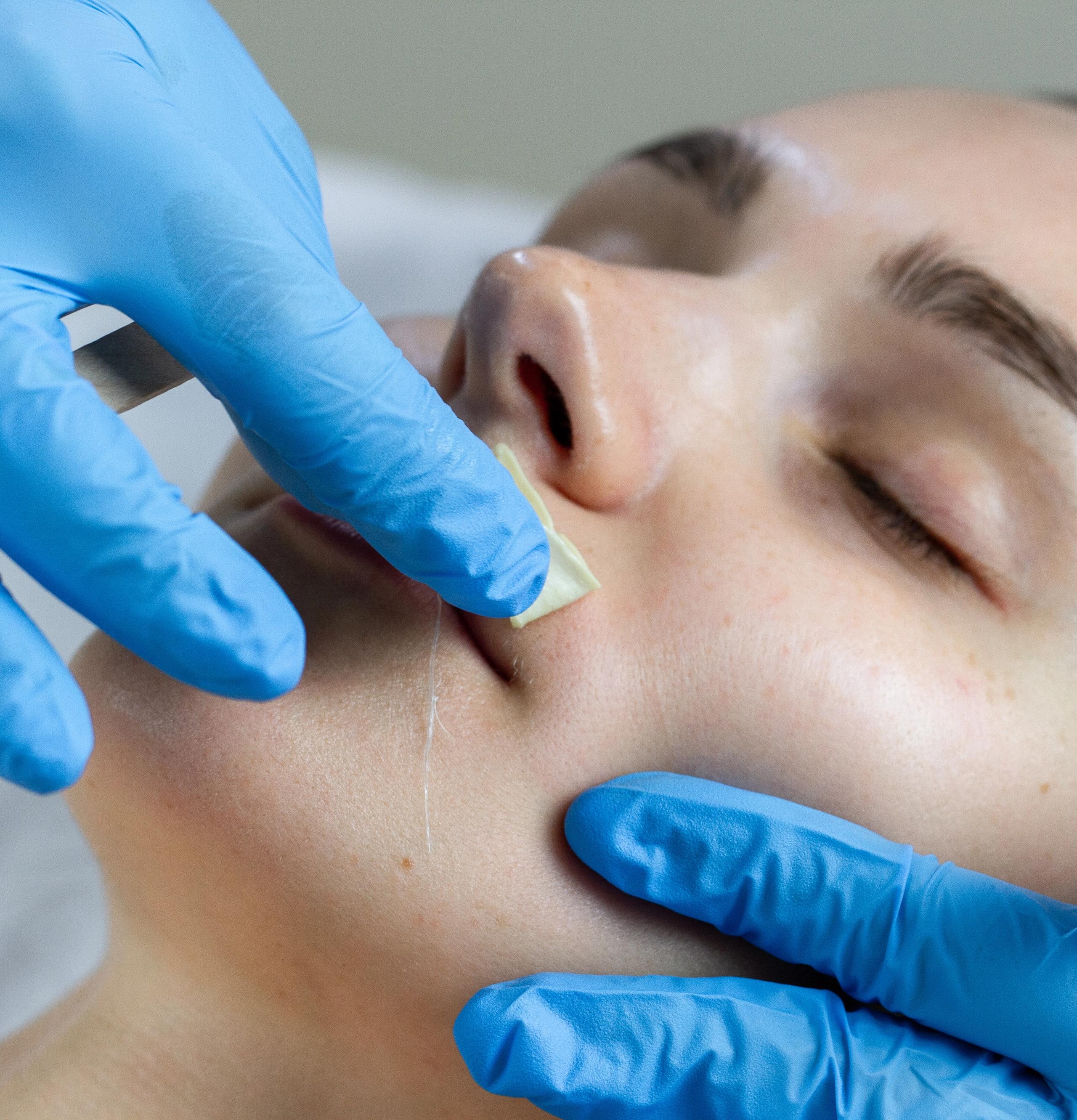 Woman getting upper lip waxed by gloved hands.