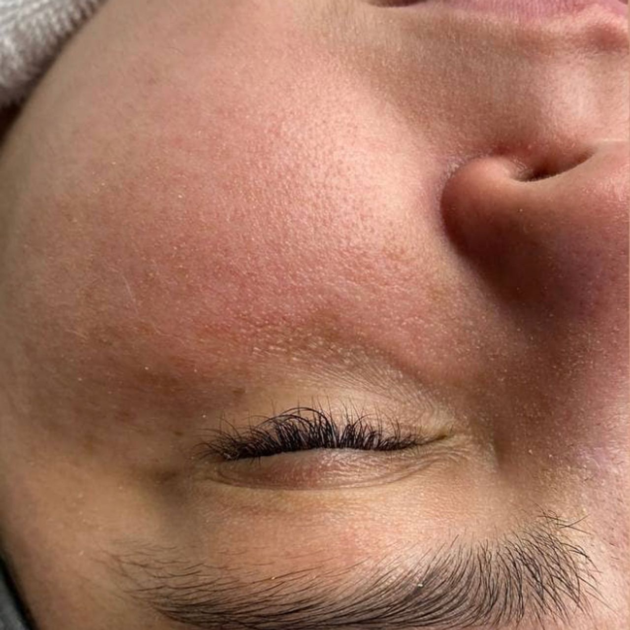 Close-up of a person's face with facial hair and dry skin patches