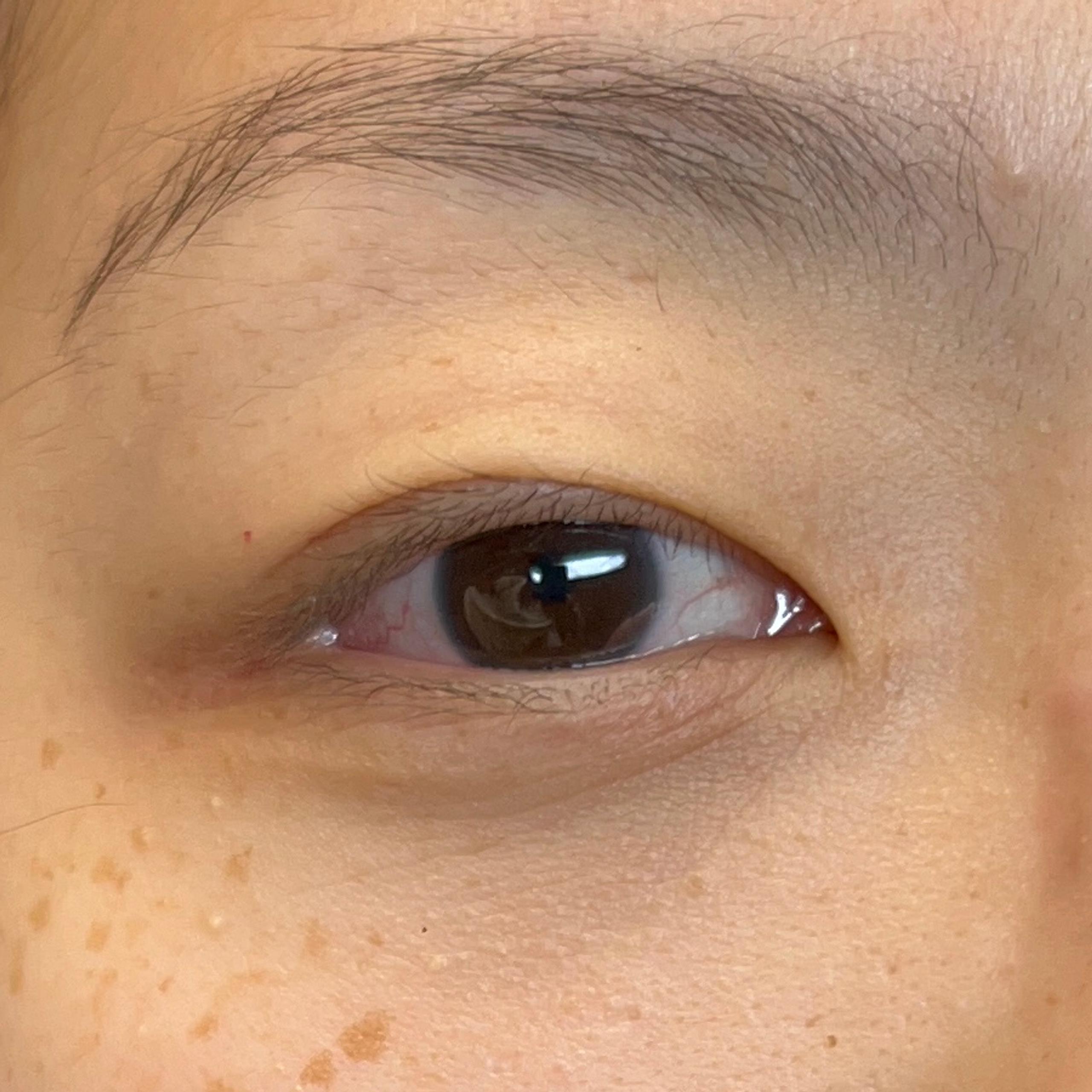 Close-up of a person's face with fair skin and numerous freckles on the cheeks and nose, brown eyes, and dark hair.