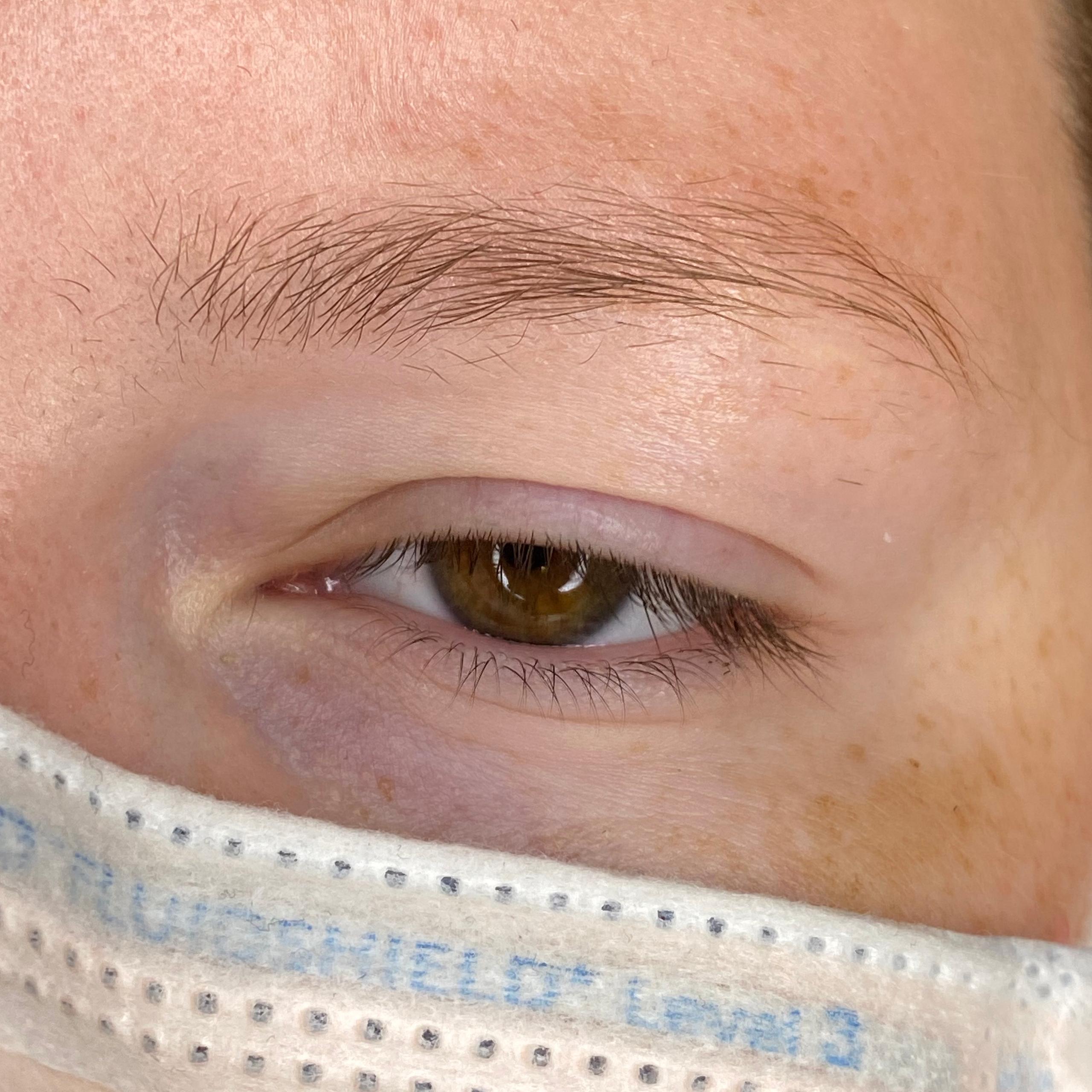 Close-up of a person's brown eye with a bruise underneath, and a white surgical mask covering the lower face.