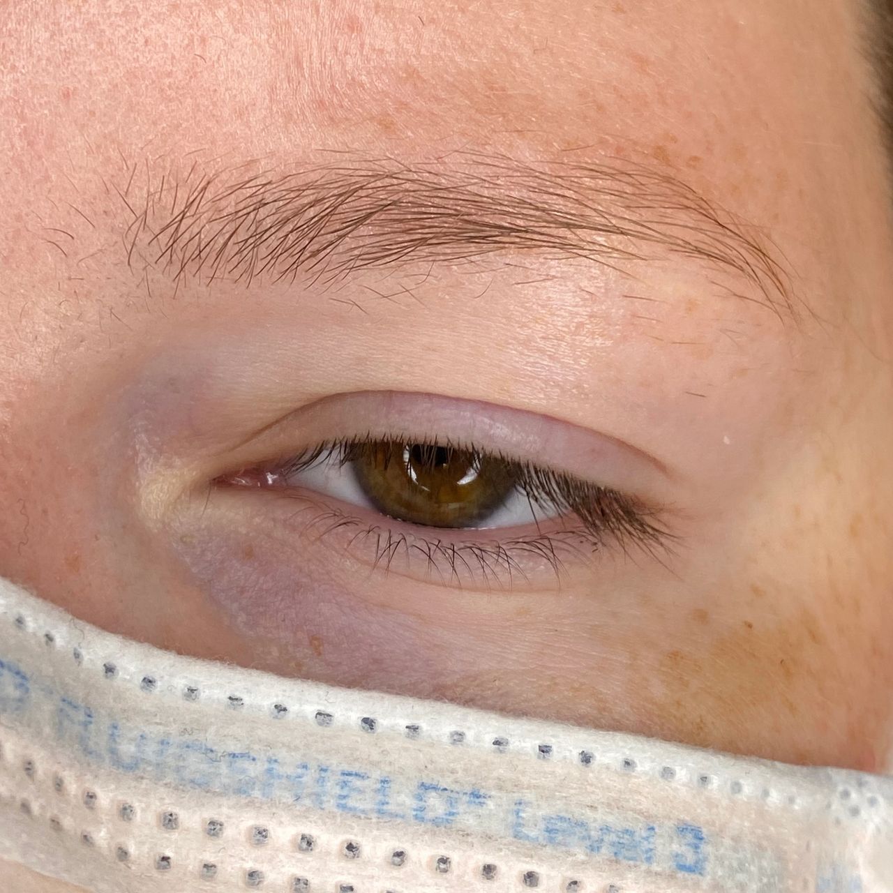 Close-up of a person's brown eye with a bruise underneath, and a white surgical mask covering the lower face.