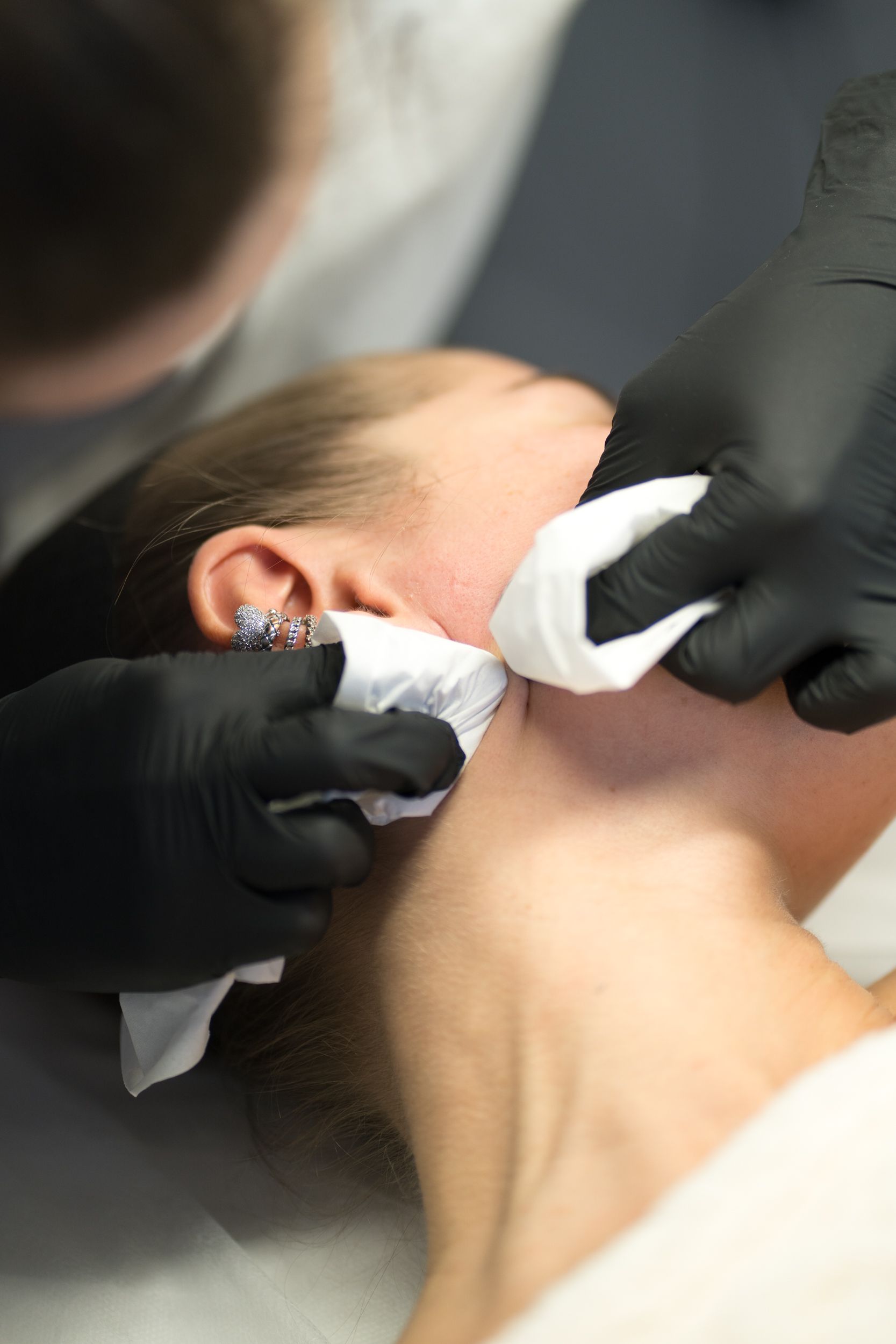 Gloved hands performed extractions on a client's jawline.
