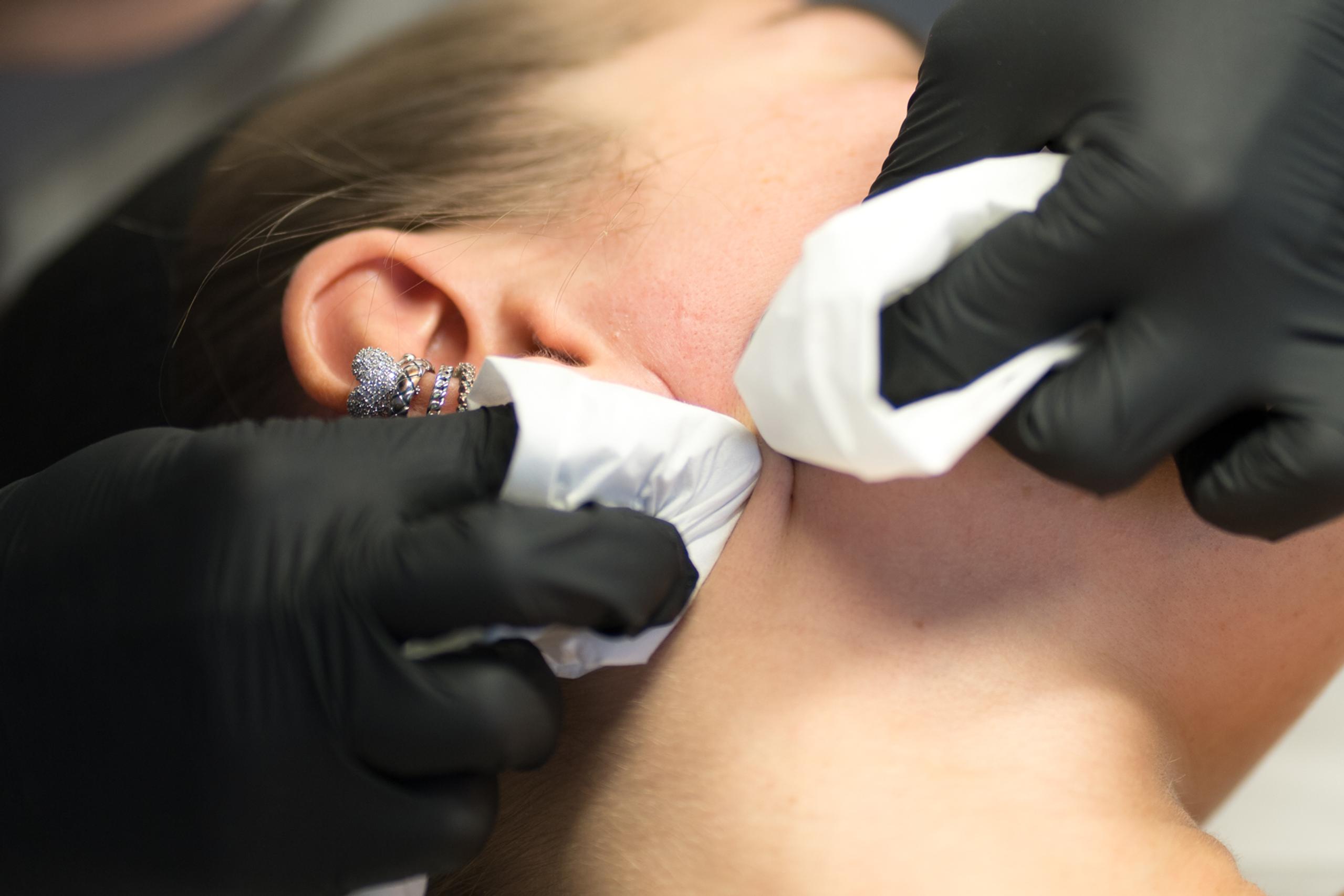 Gloved hands performed extractions on a client's jawline.