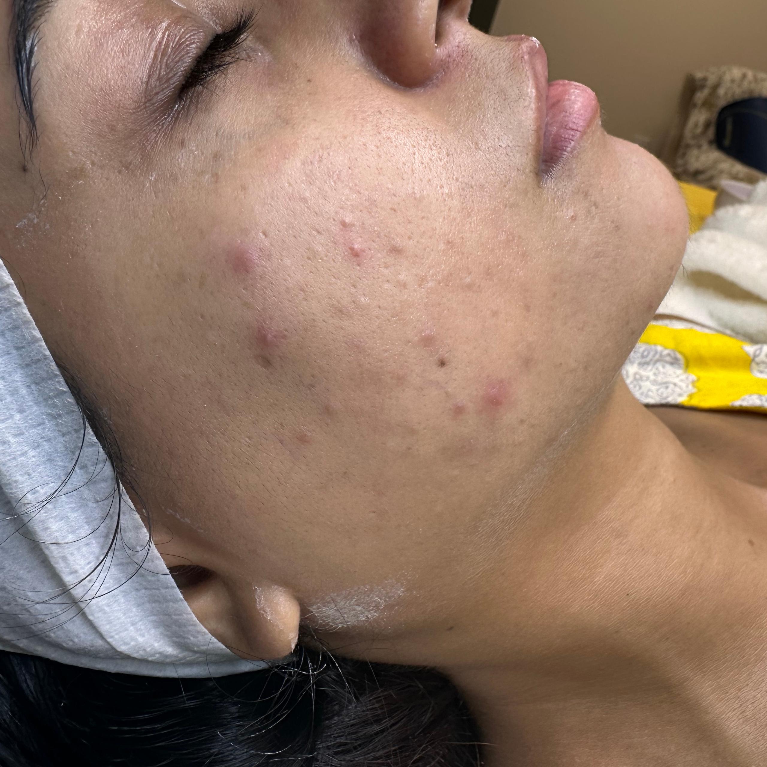 A person's face in profile showing acne on their cheek and jawline.