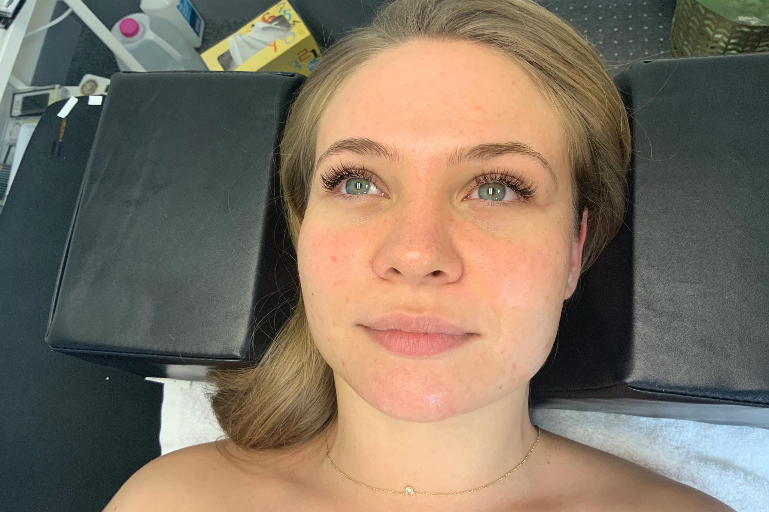 Client resting on a treatment bed after classic eyelash extensions