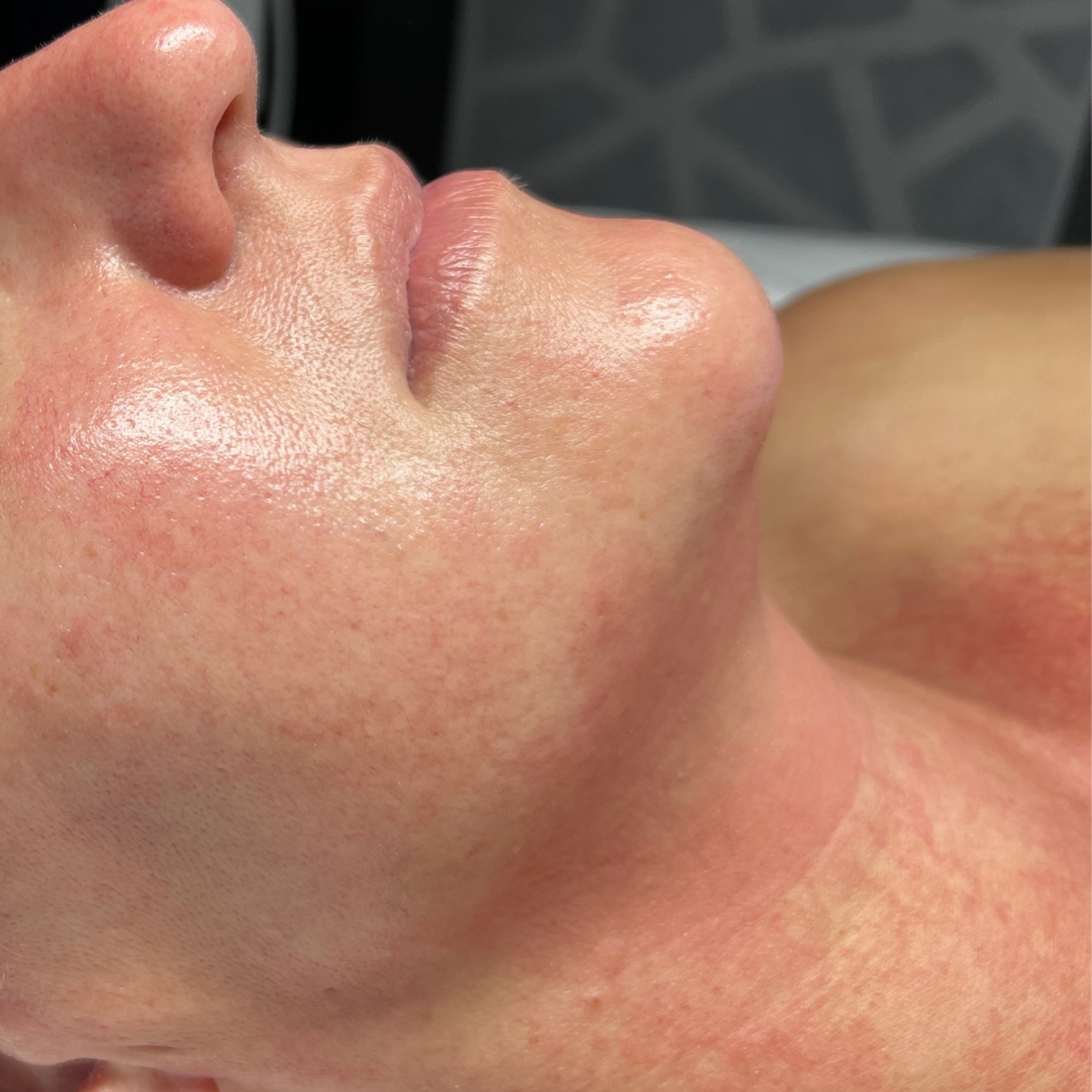 Side profile of a person's face and neck with improved skin, labeled "AFTER".