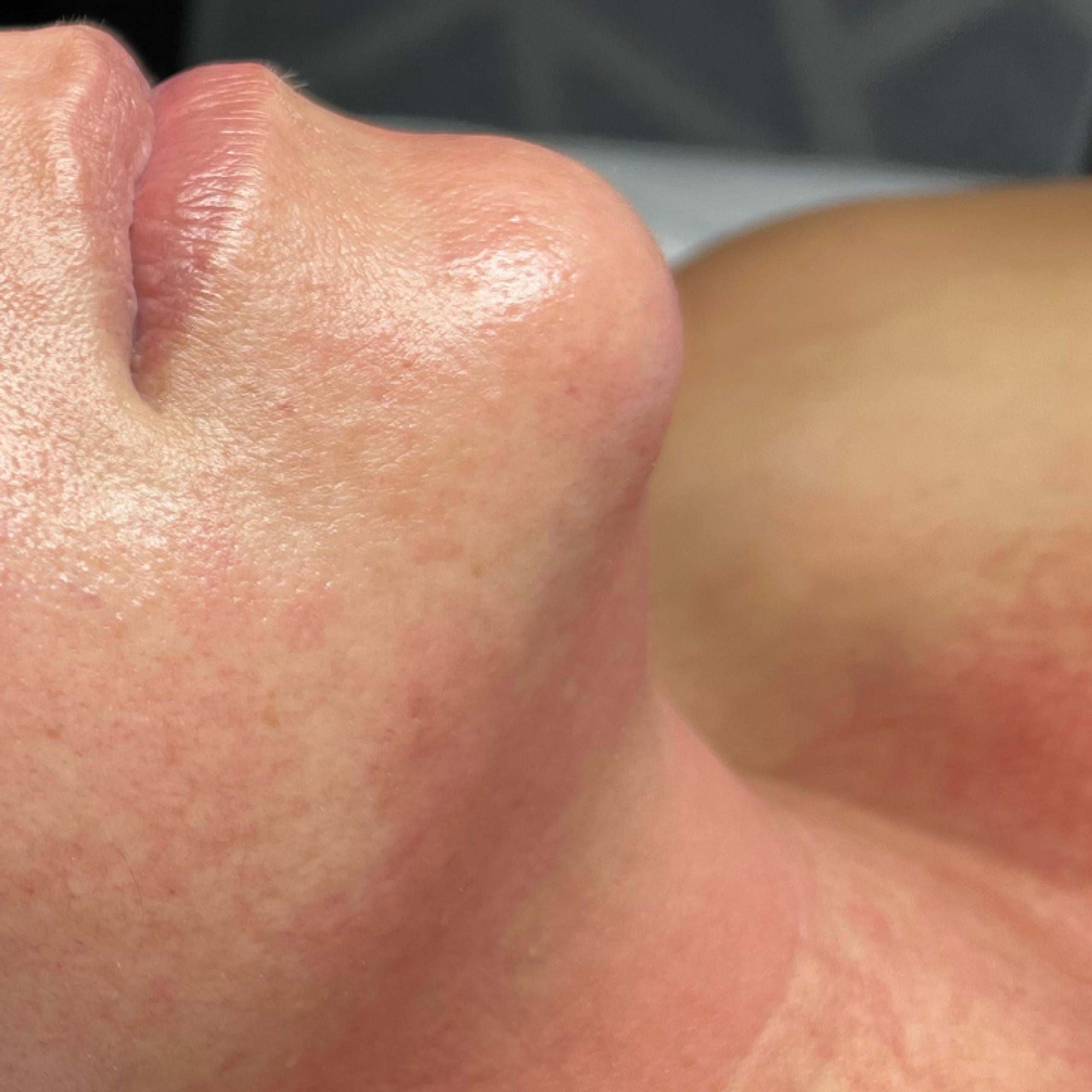 Side profile of a person's face and neck with improved skin, labeled "AFTER".