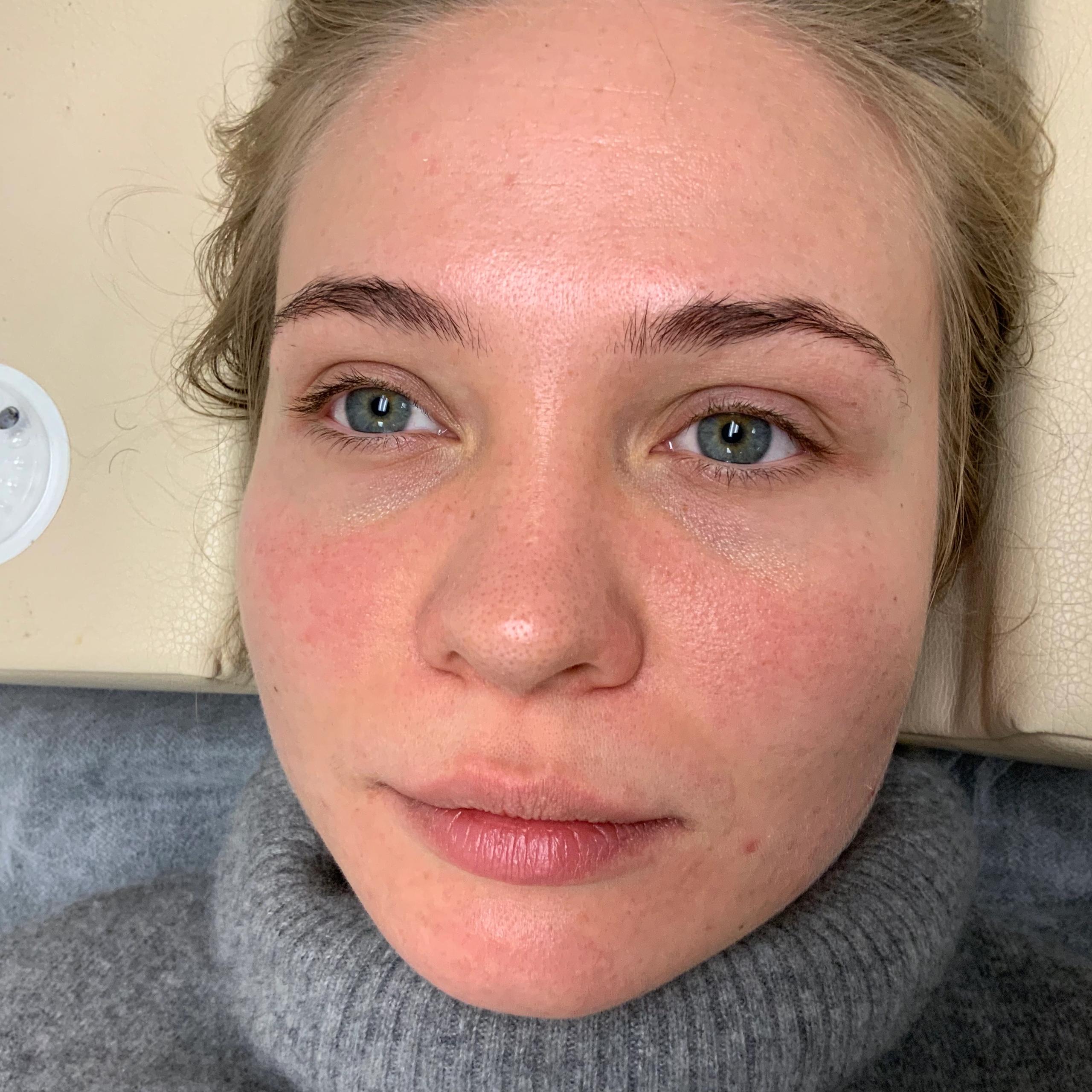 Fair-skinned woman with flushed face and blue eyes, lying down, with a small tray of tools to her left.