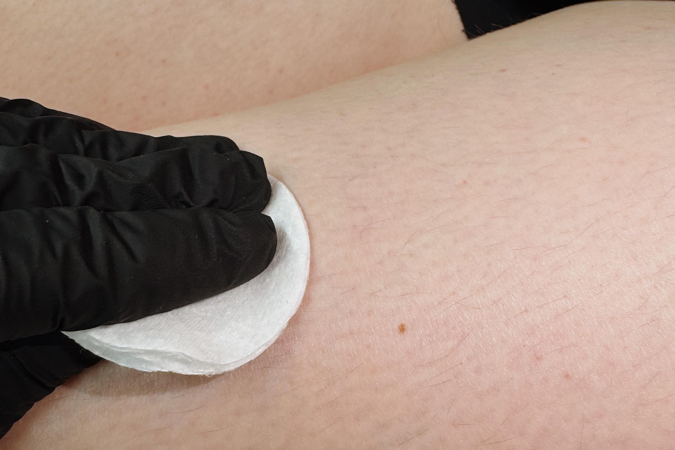 a girl's leg, a hand in a gloves, and a cotton pad