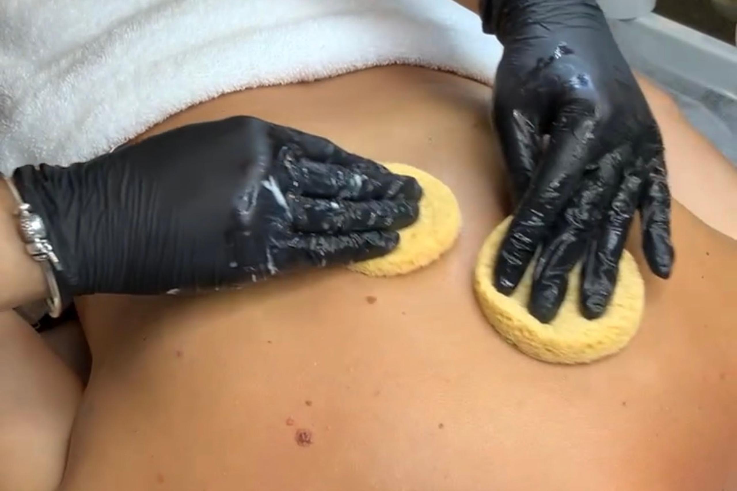 Gloved hands cleaning a person's back with yellow sponges.