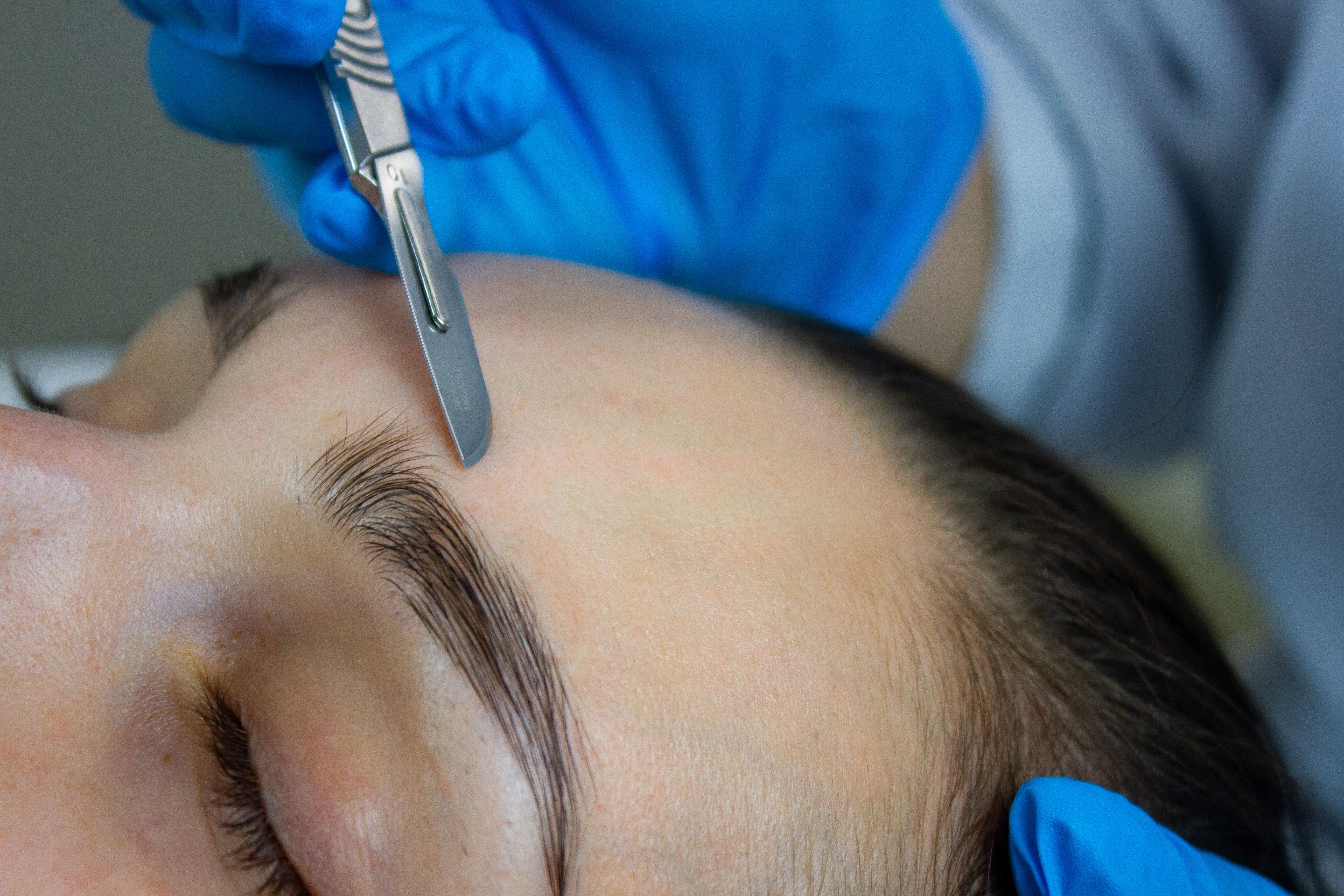 A gloved hand uses a scalpel for dermaplaning on a person's forehead.