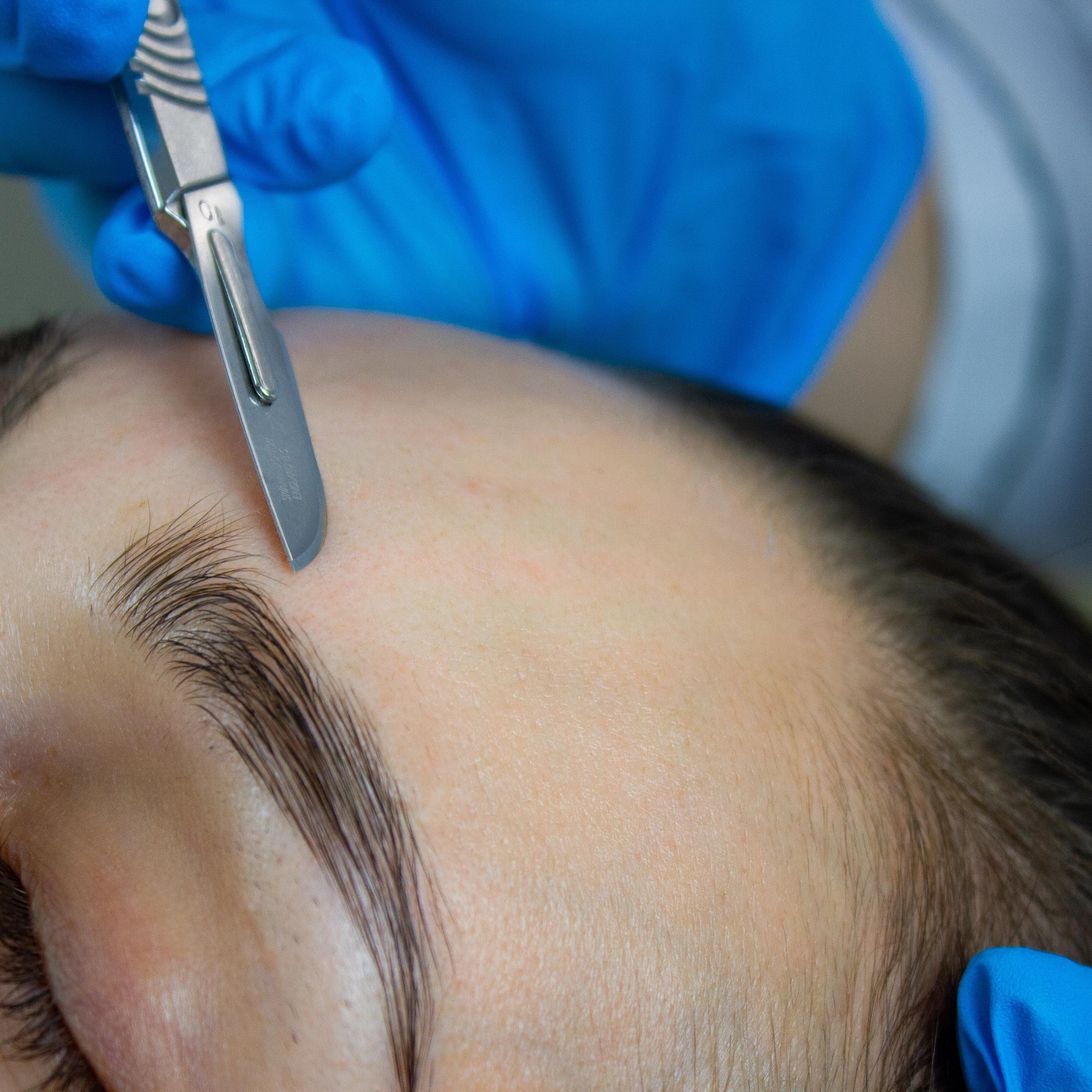 A gloved hand uses a scalpel for dermaplaning on a person's forehead.