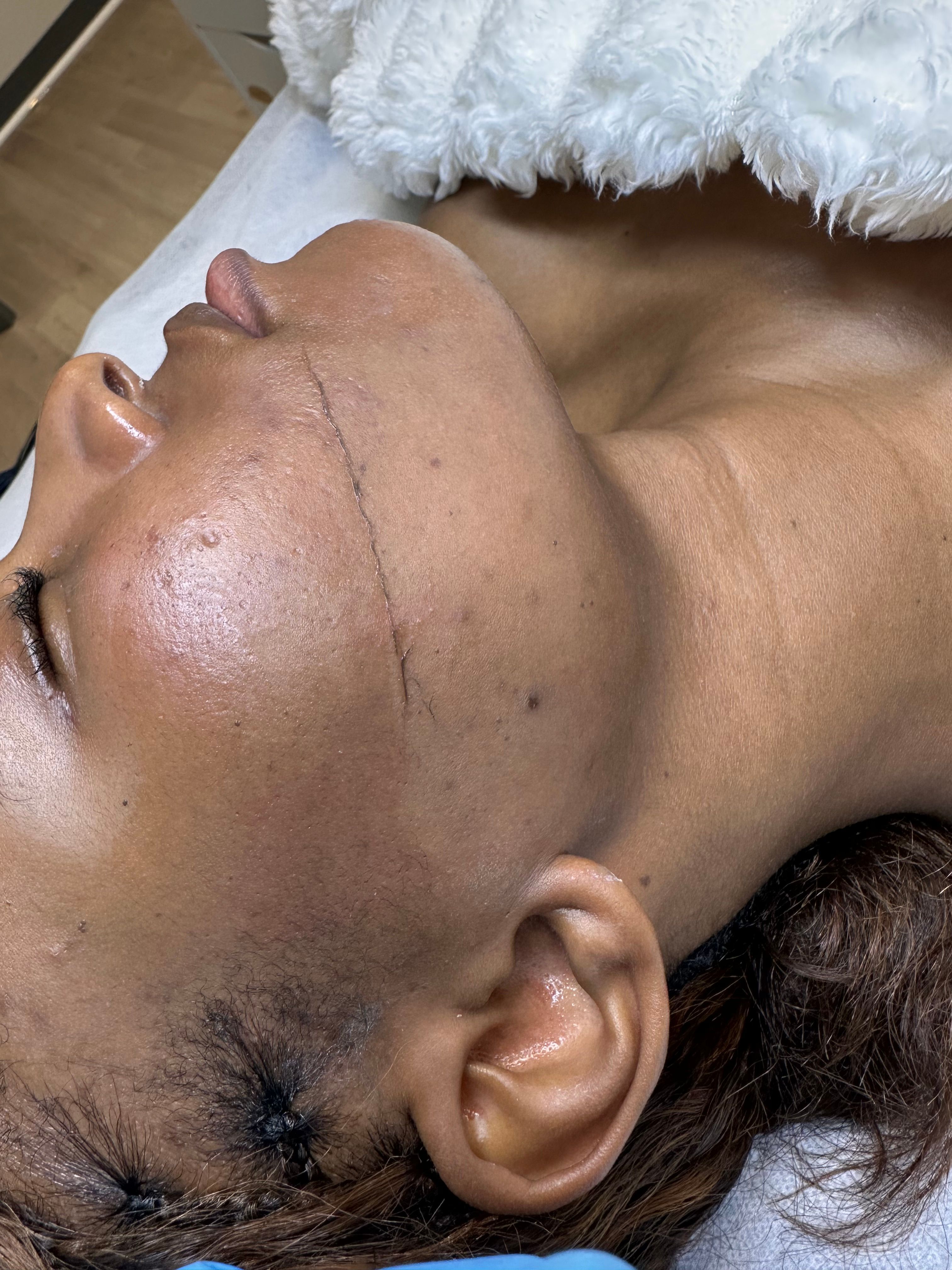 Profile of a person with a half of the face dermaplaned