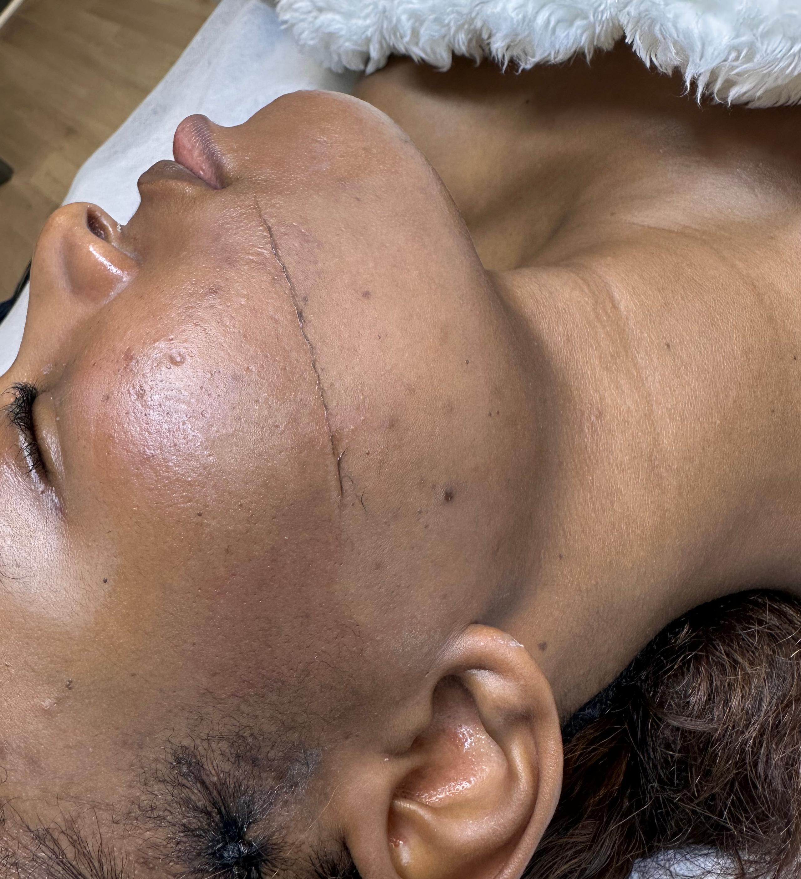 Profile of a person with a half of the face dermaplaned