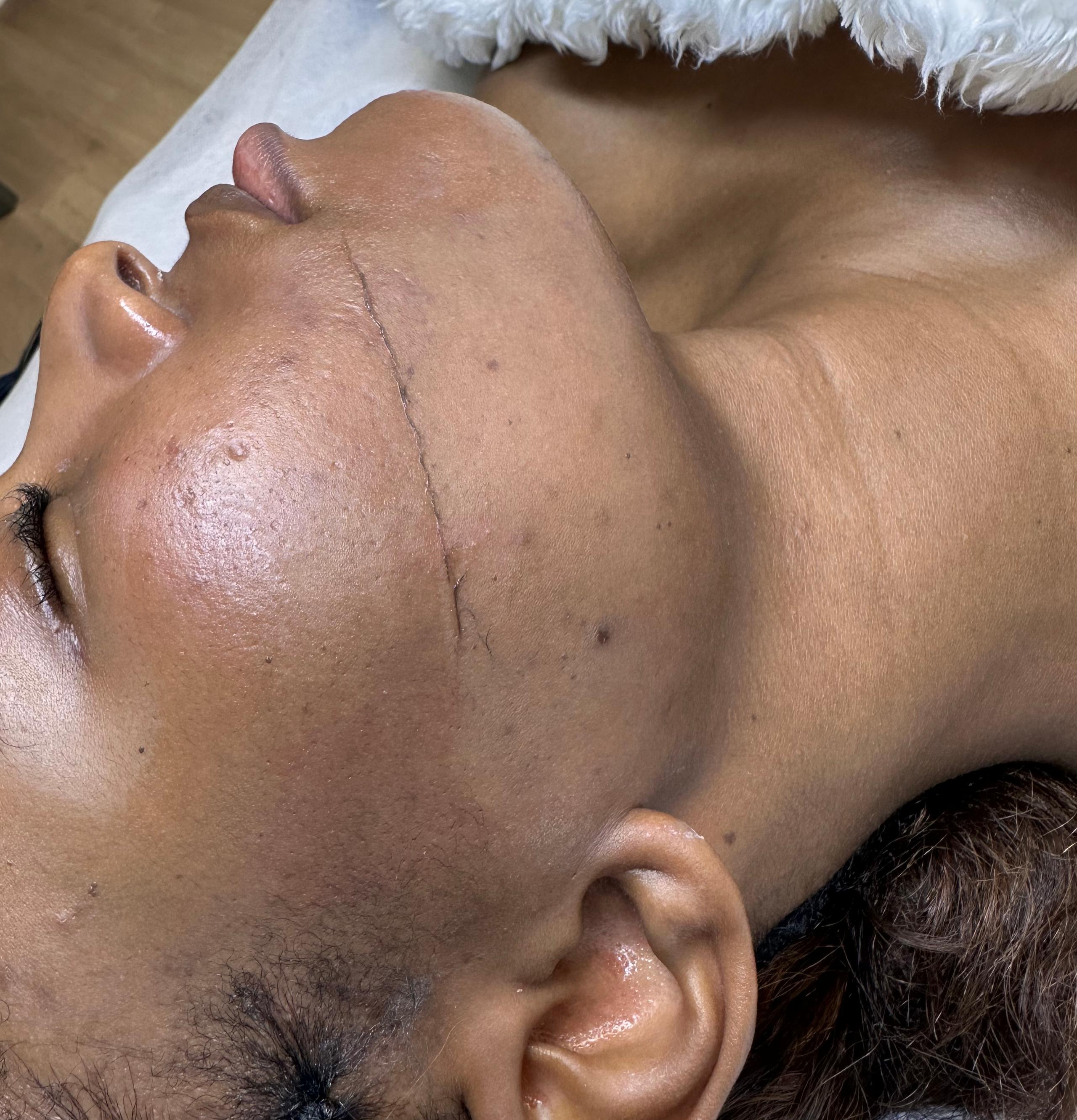 Profile of a person with a half of the face dermaplaned