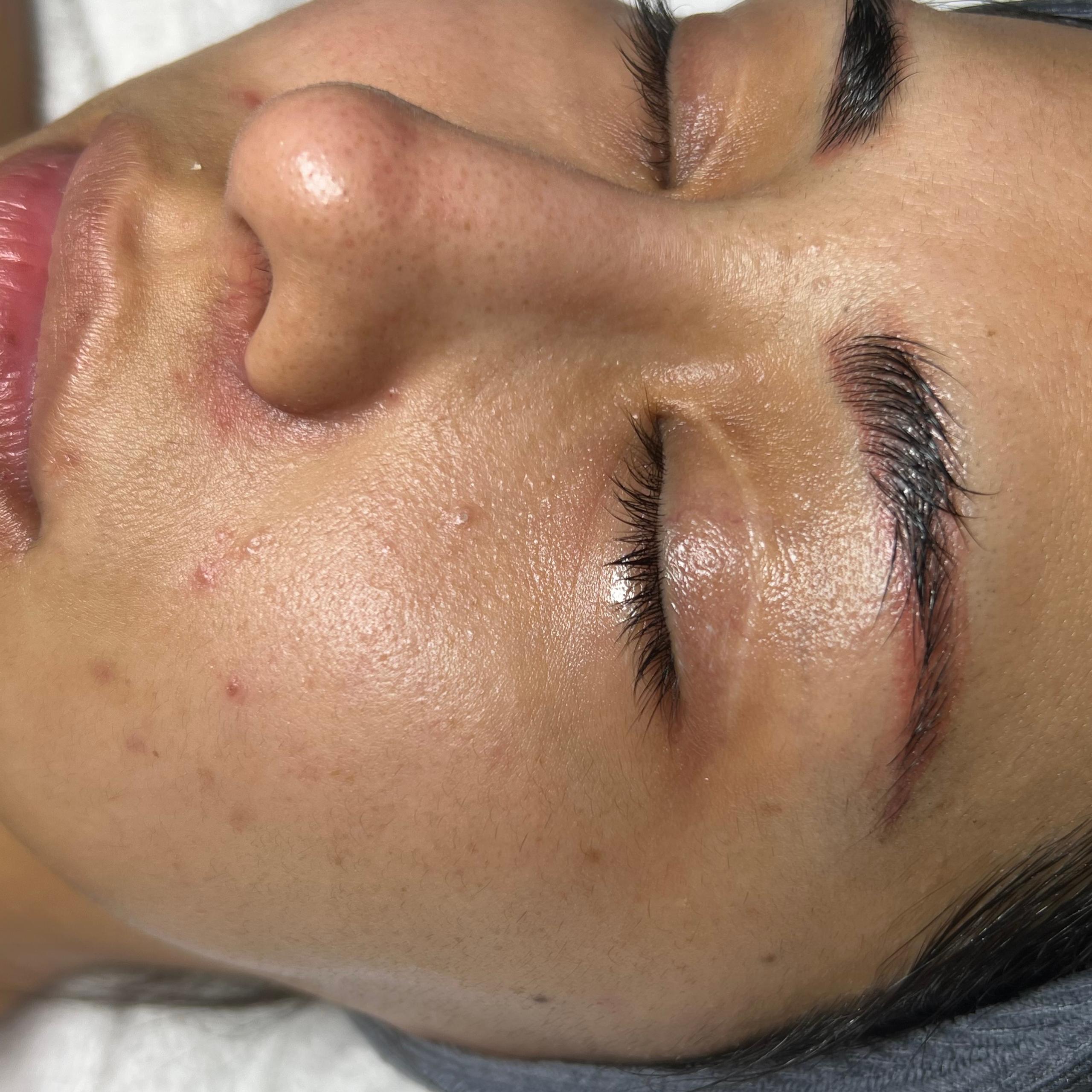 A person's face with eyes closed, showing skin with blemishes