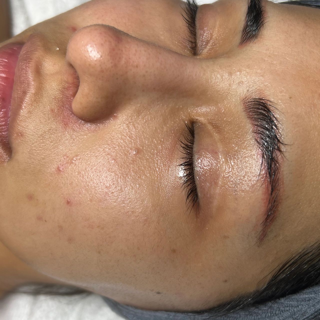 A person's face with eyes closed, showing skin with blemishes