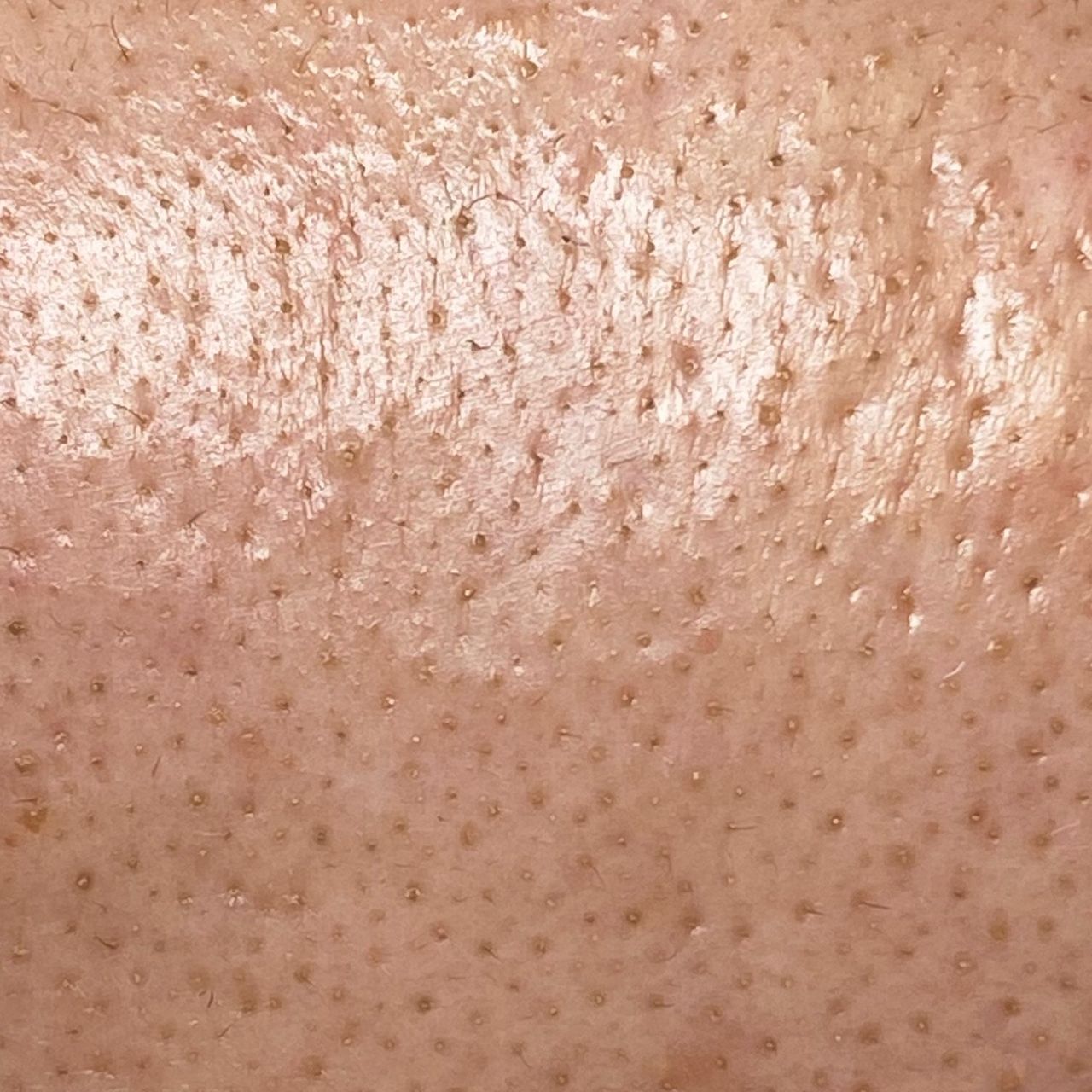 Close-up of a forehead with enlarged pores and uneven skin texture.