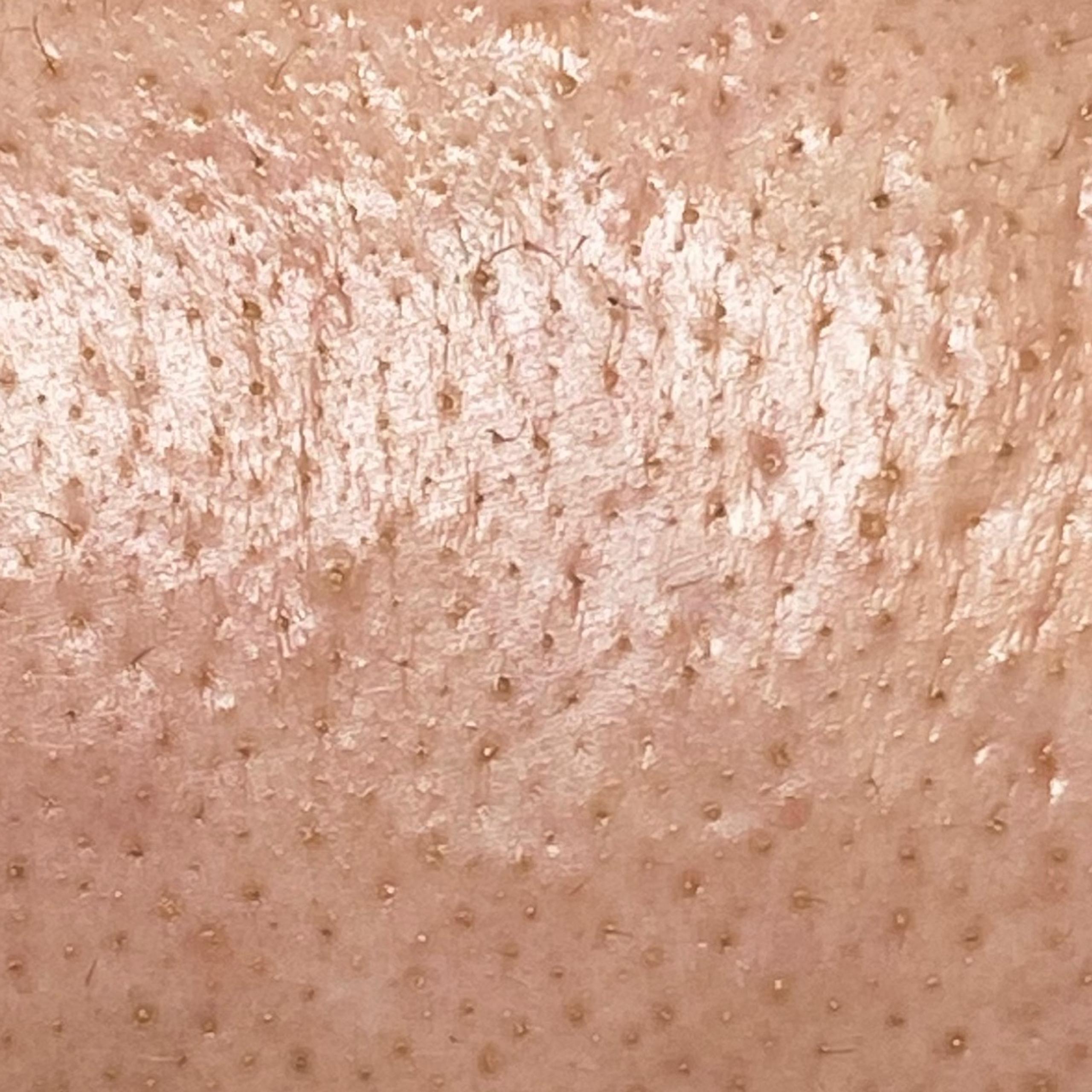 Close-up of a forehead with enlarged pores and uneven skin texture.