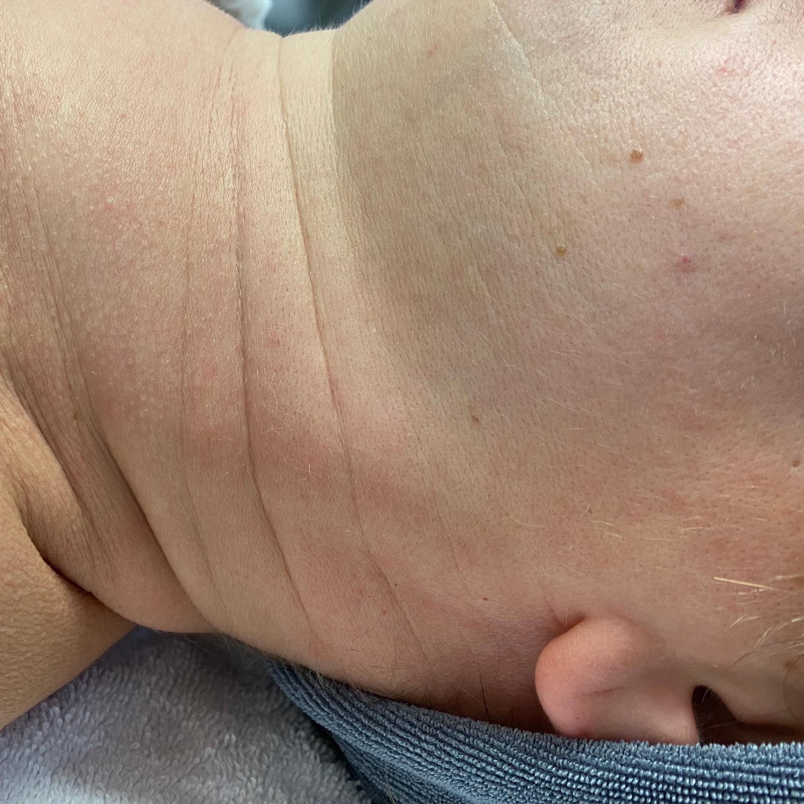 Side profile of a person's neck and lower face, showing prominent horizontal neck wrinkles.