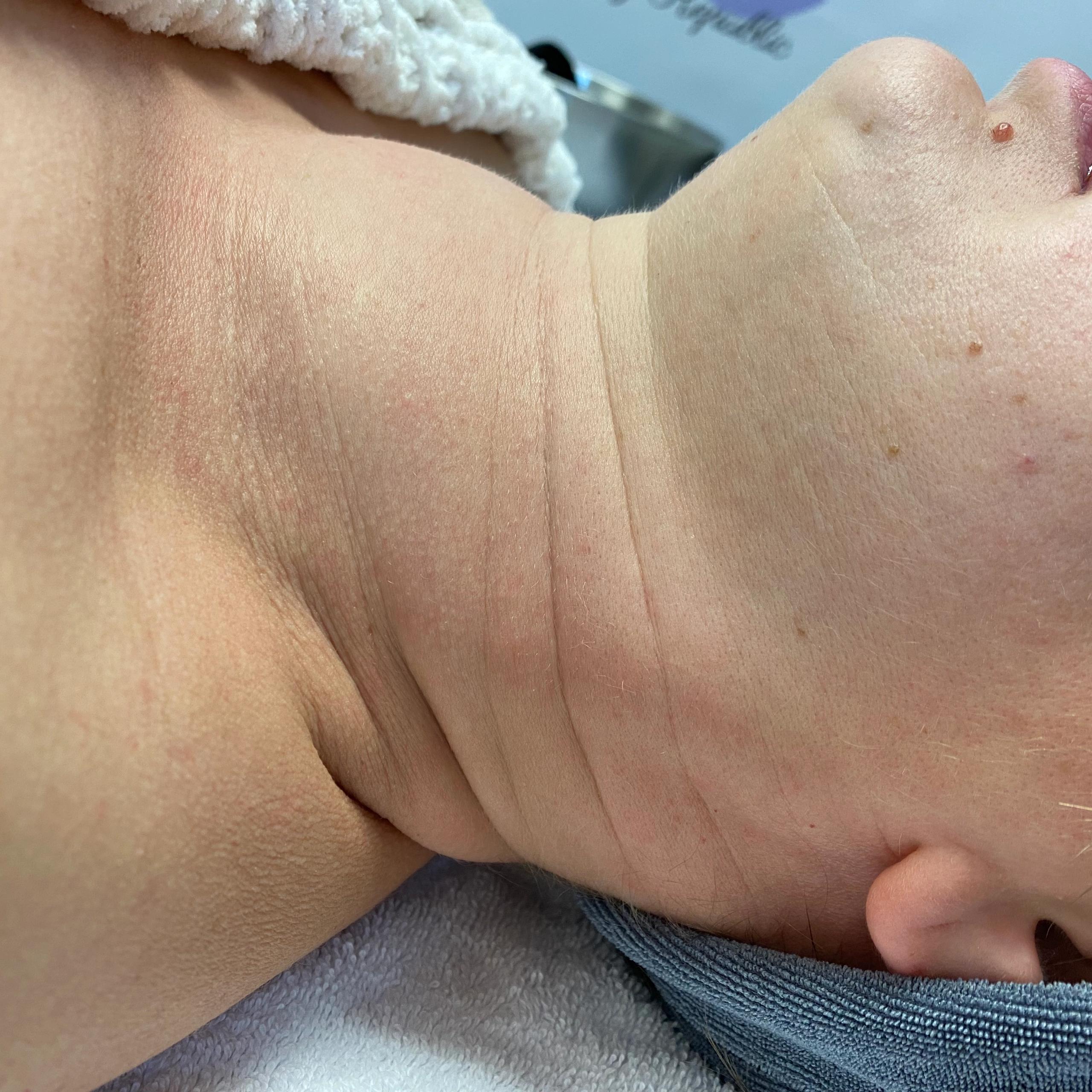 Side profile of a person's neck and lower face, showing prominent horizontal neck wrinkles.