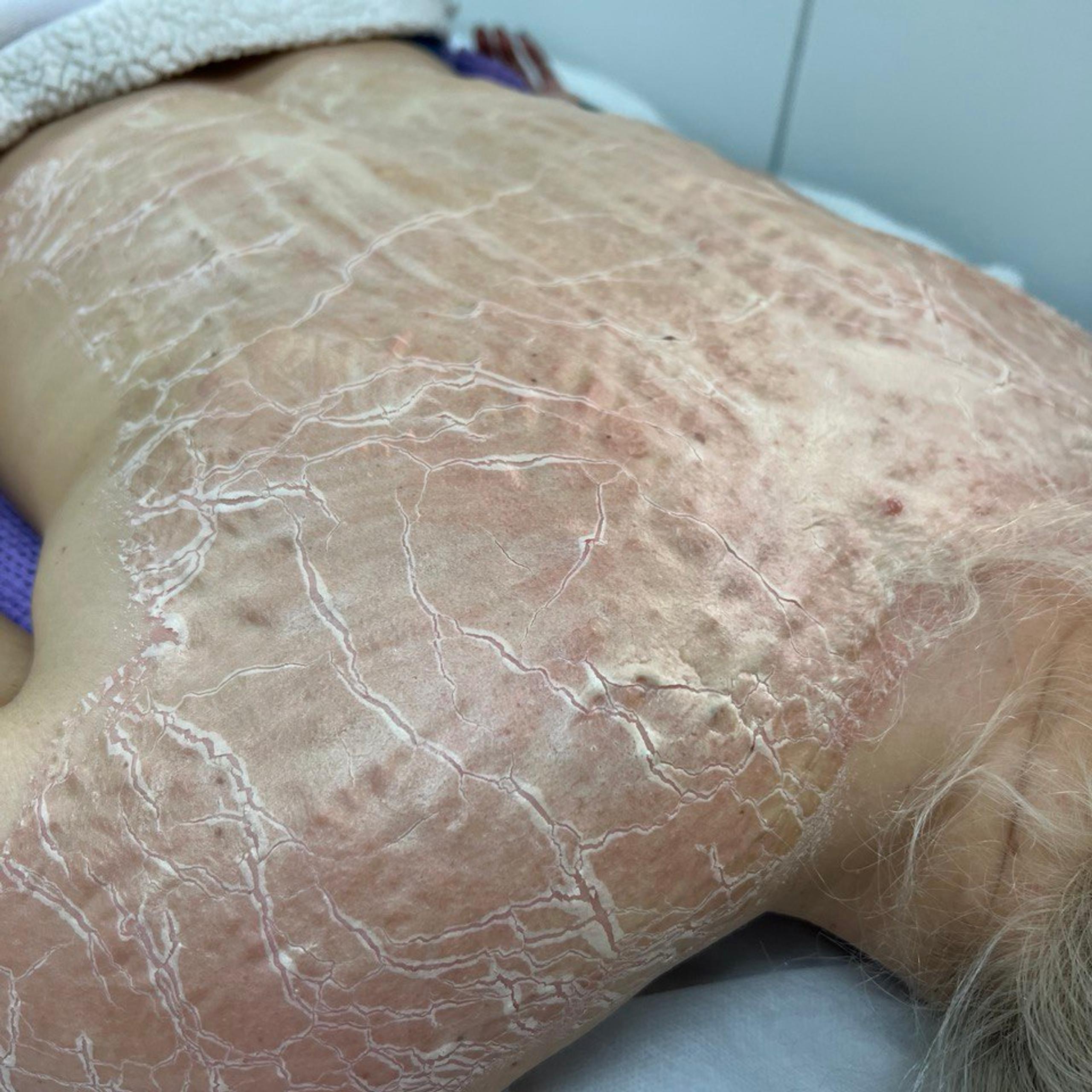 A person's back and shoulder covered in severely dry, cracked mask