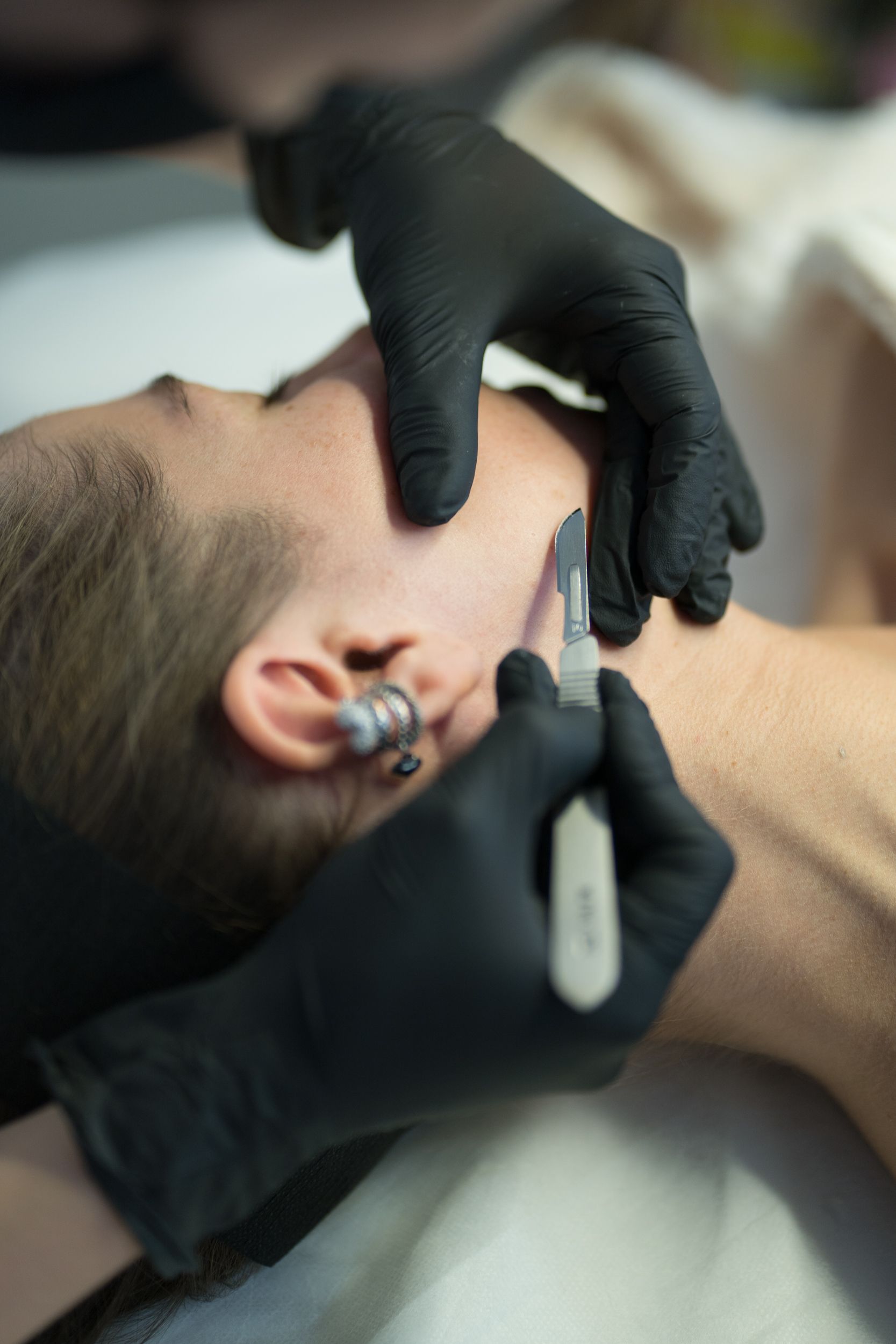 Gloved hands perform dermaplaning with a scalpel on a person's face.