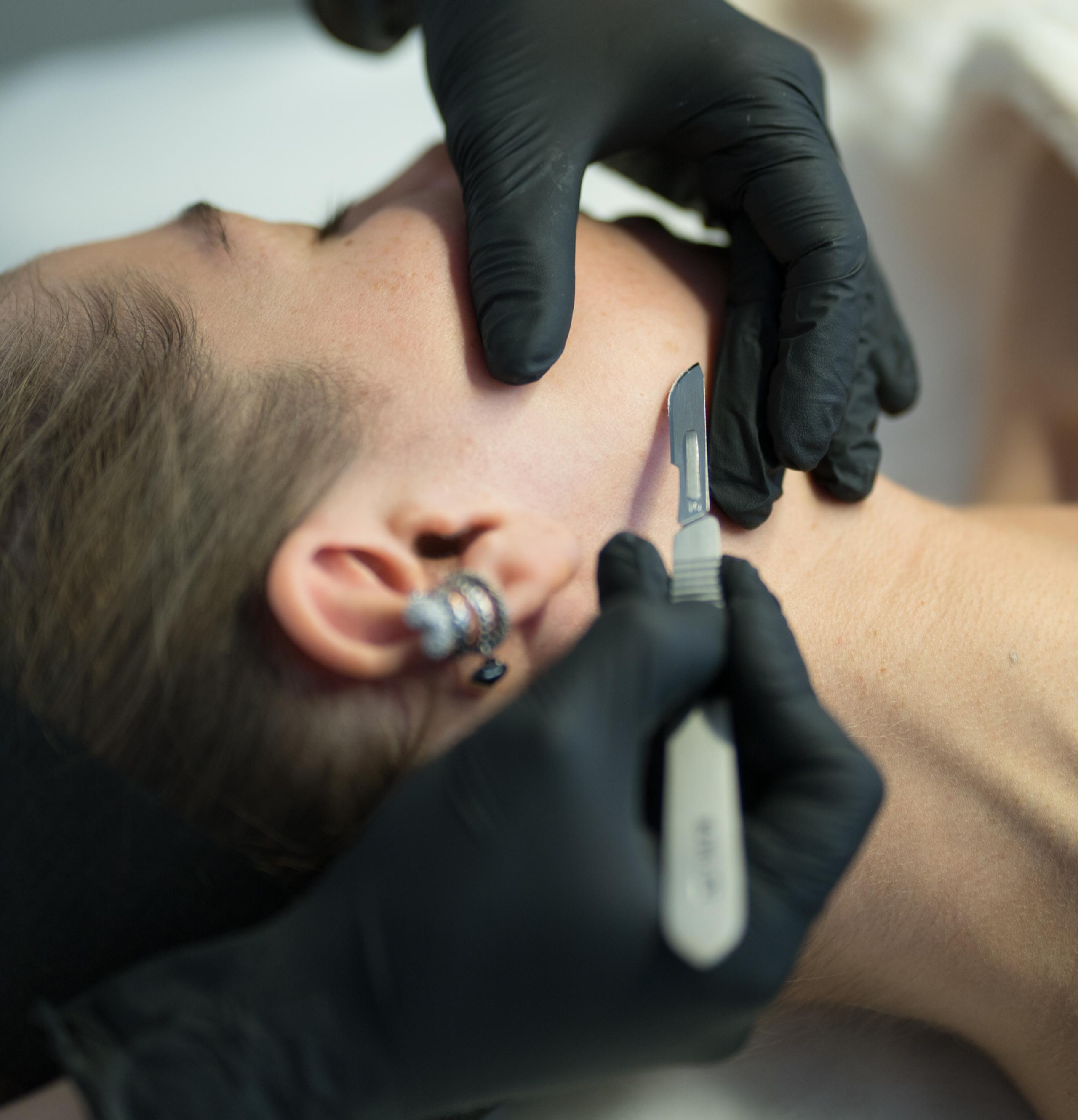 Gloved hands perform dermaplaning with a scalpel on a person's face.