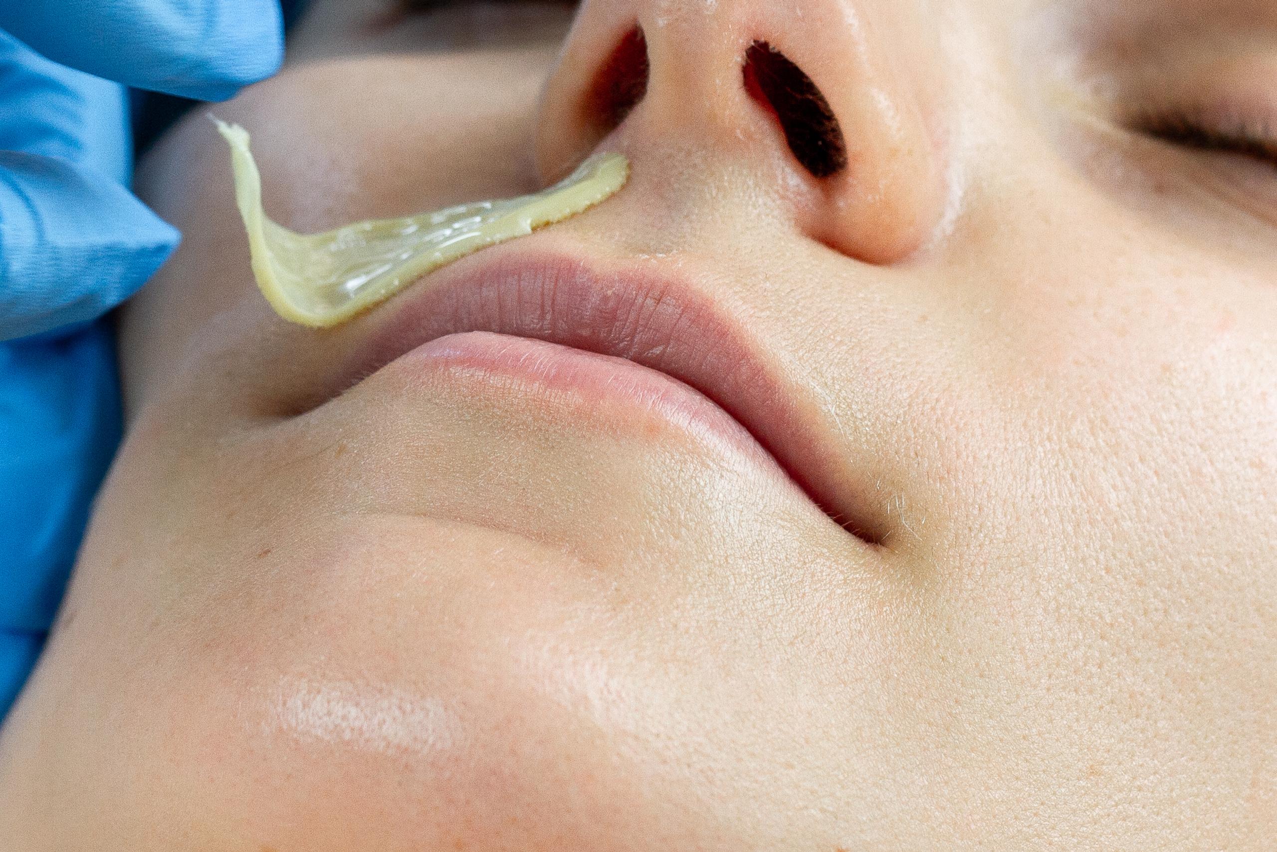 A gloved hand applies yellow wax to a person's upper lip.