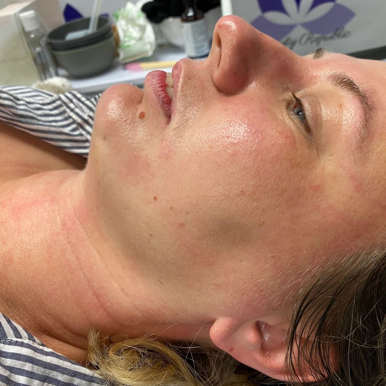 A woman's face showing visibly improved skin elasticity and less wrinkles.