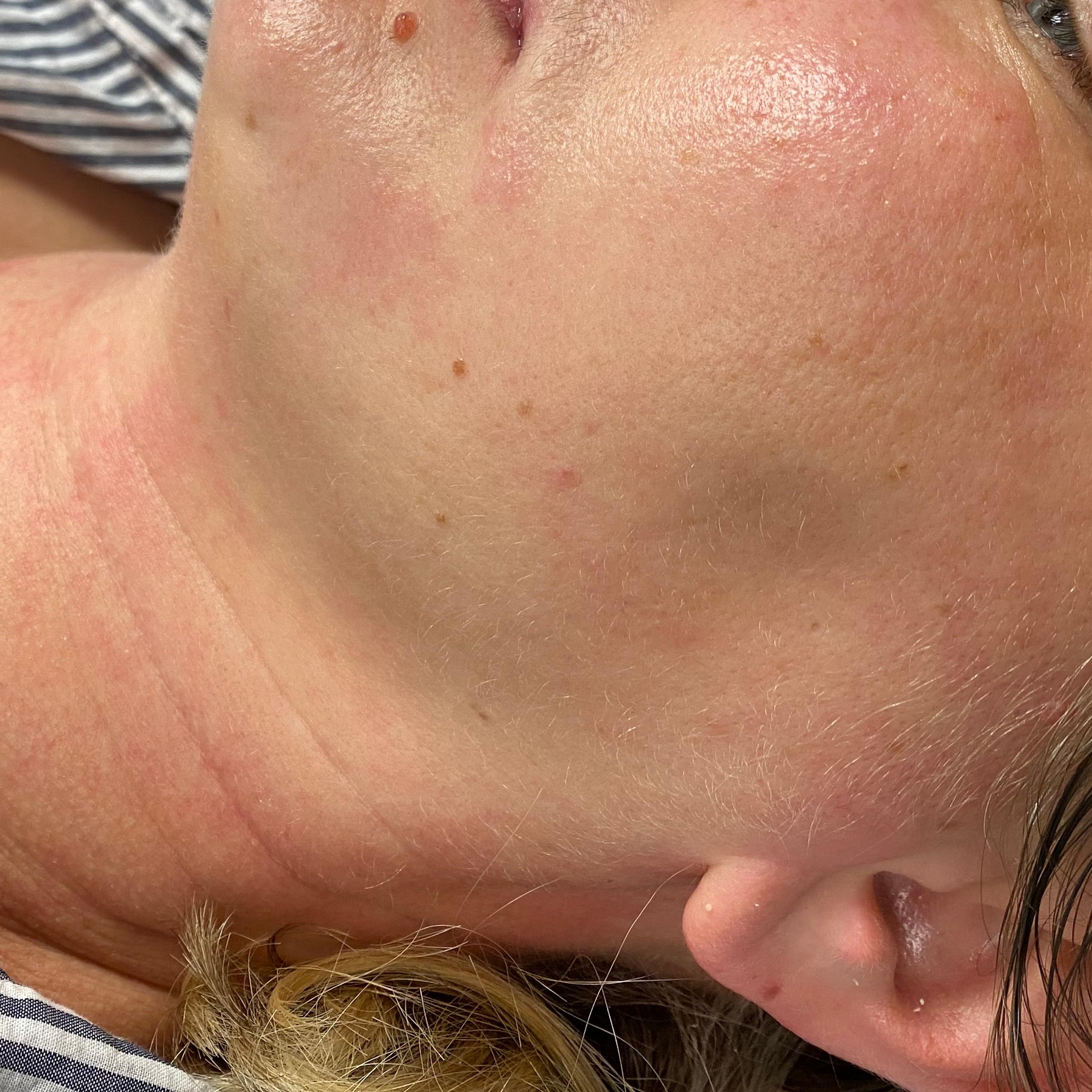 A woman's face showing visibly improved skin elasticity and less wrinkles.