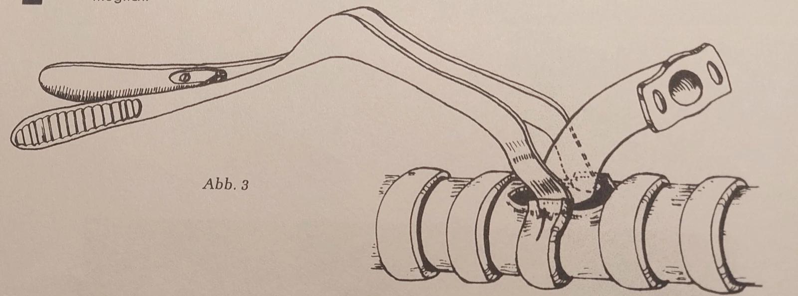 Drawing showing the application of the spreading speculum to the trachea.