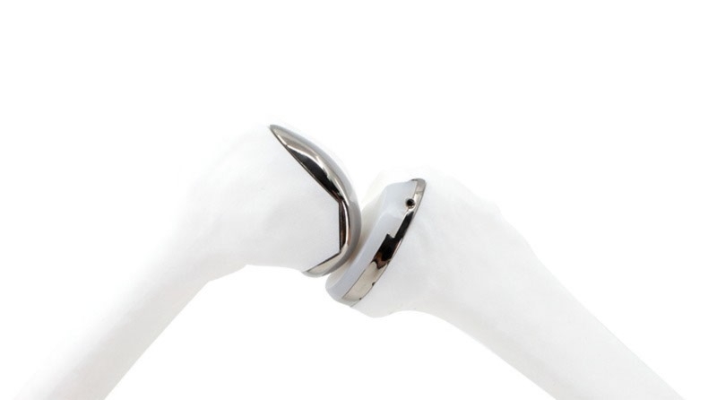 Tsolution One Advanced Orthopedic Technology for Custom Joint Replacement