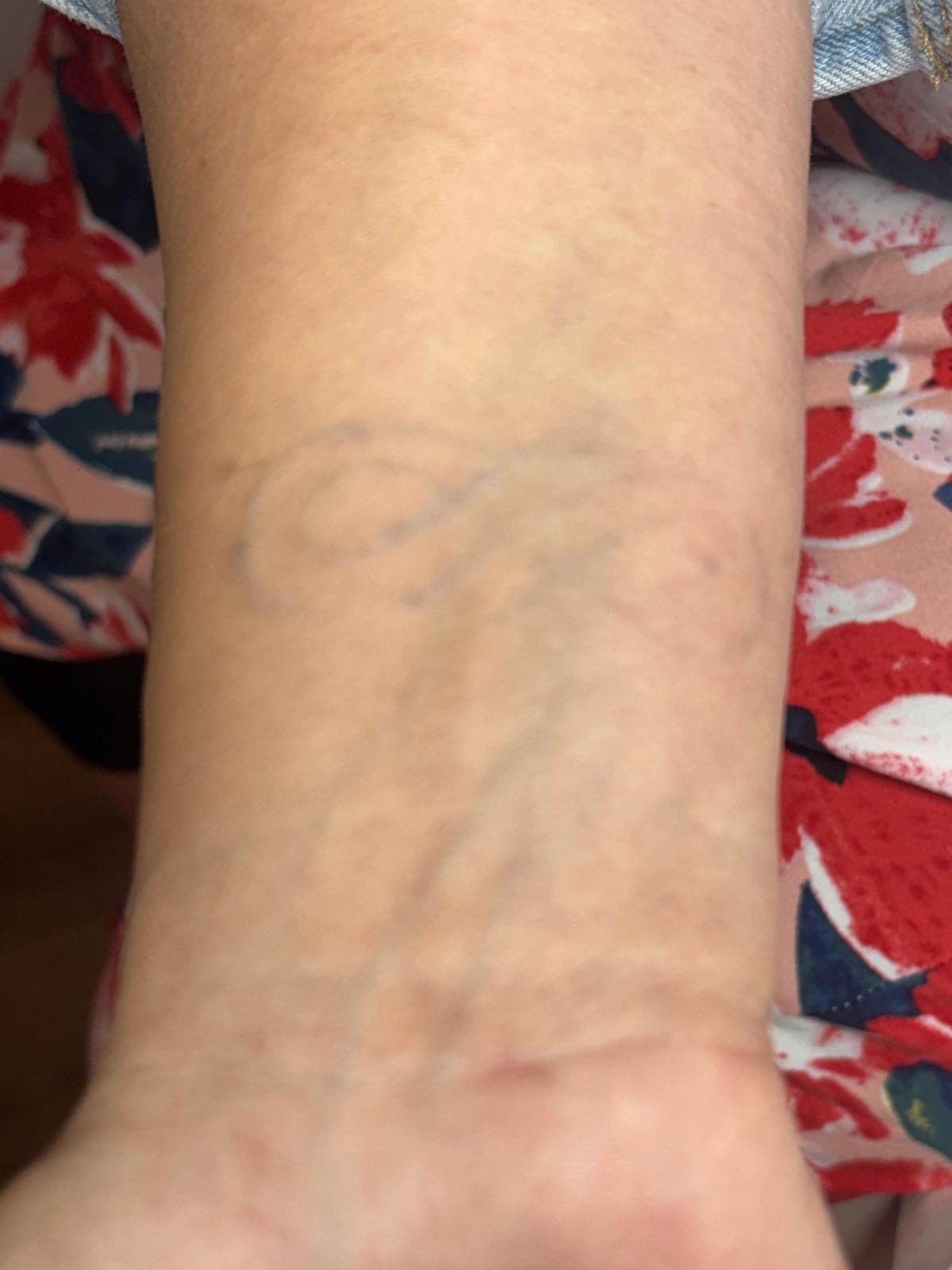Détatouage à Caen : ce qu’il faut savoir avant de se faire tatouer