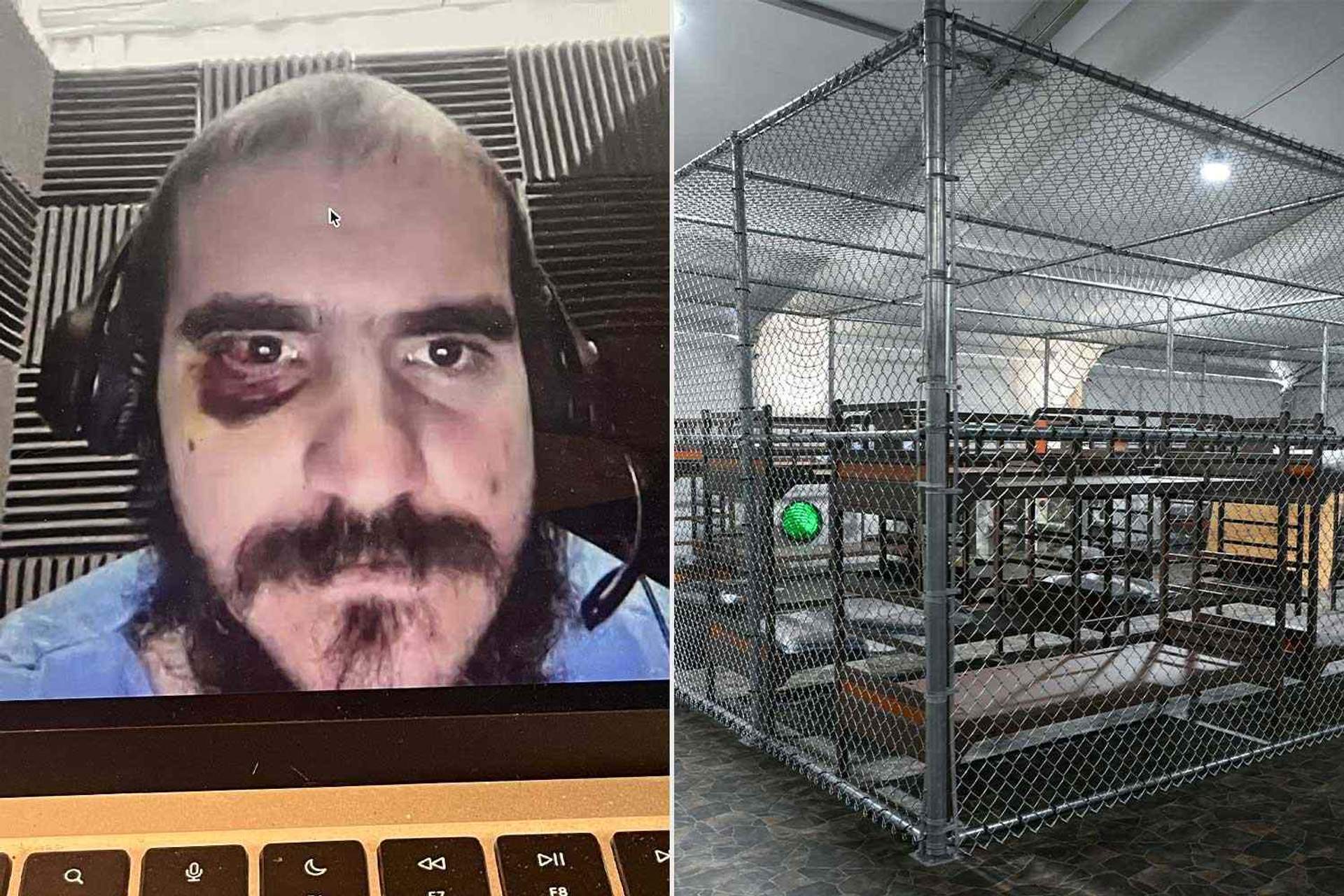Detainee from 'Alligator Alcatraz' appears on video call with black eye and battered face.