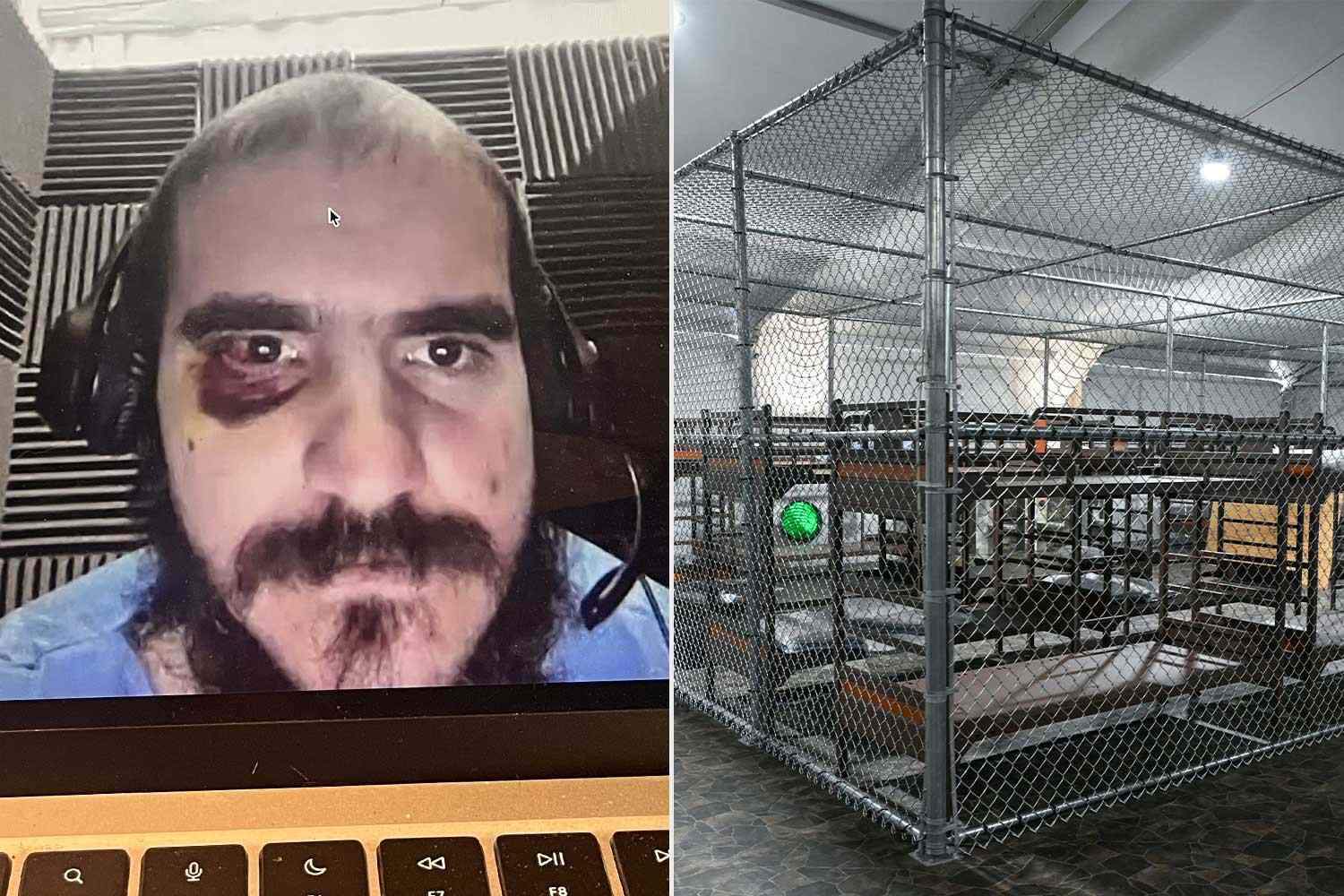 Detainee from 'Alligator Alcatraz' appears on video call with black eye and battered face.