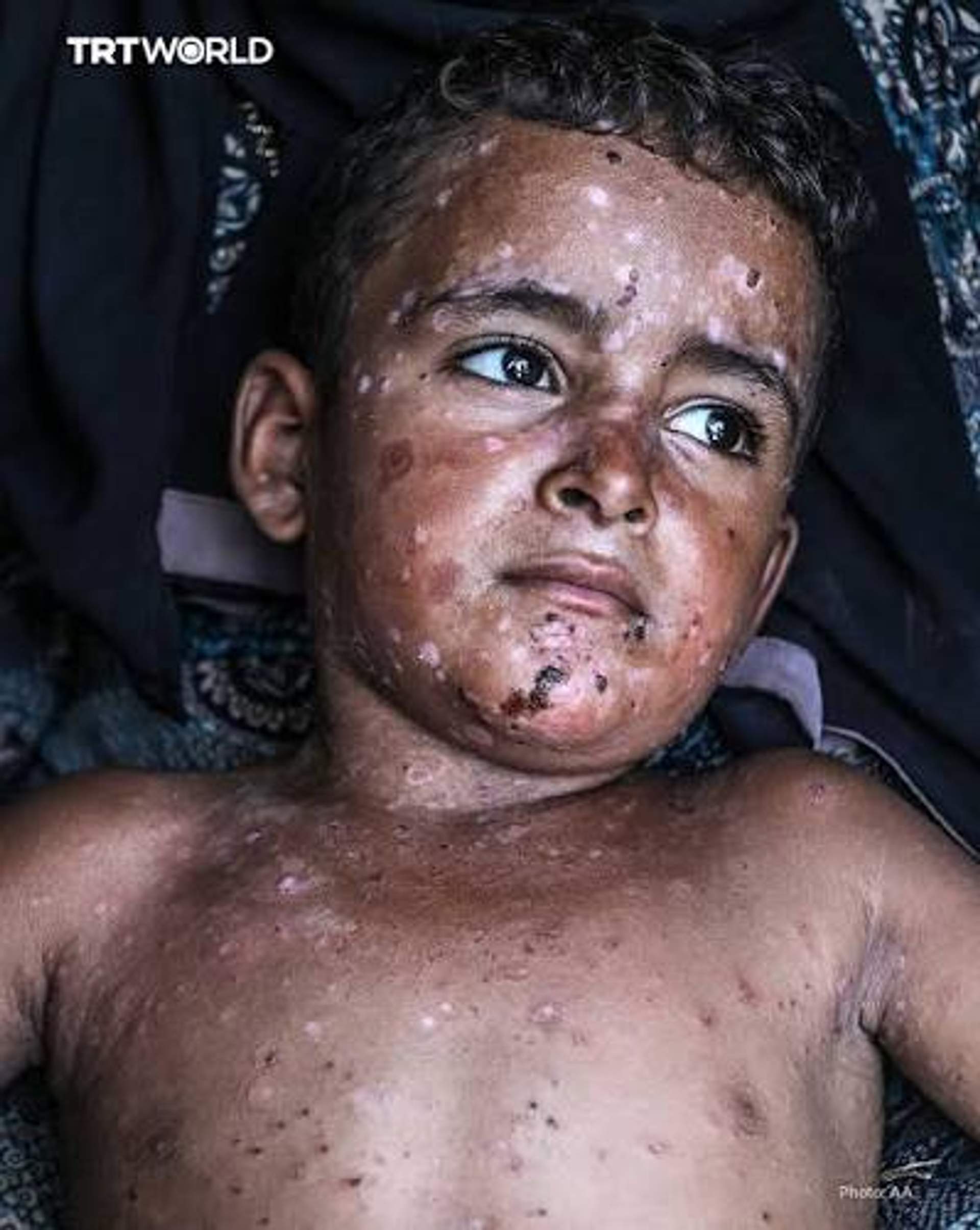 Young boy covered by chickenpox blisters with no relief isolated in a tent encampment for the displaced. There is no relief only suffering.