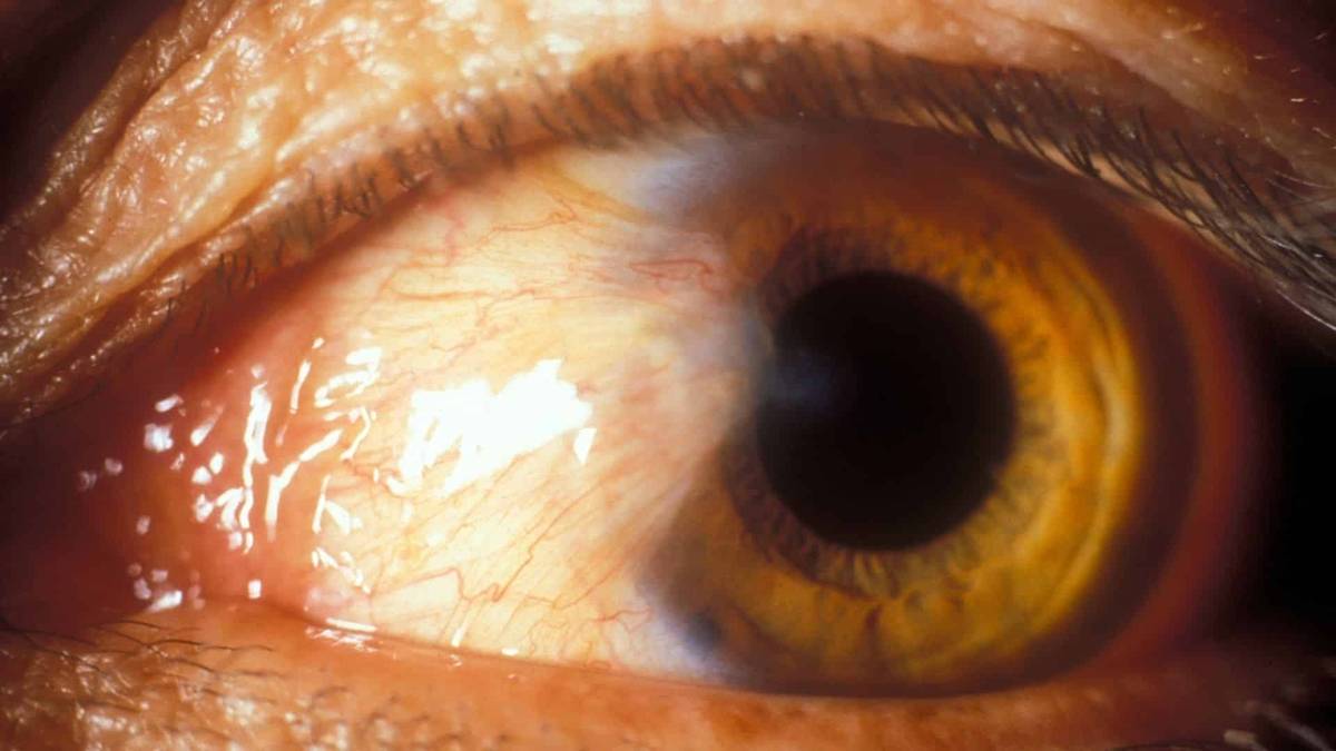 What Is Surfer’s Eye: Causes, Symptoms, And Prevention