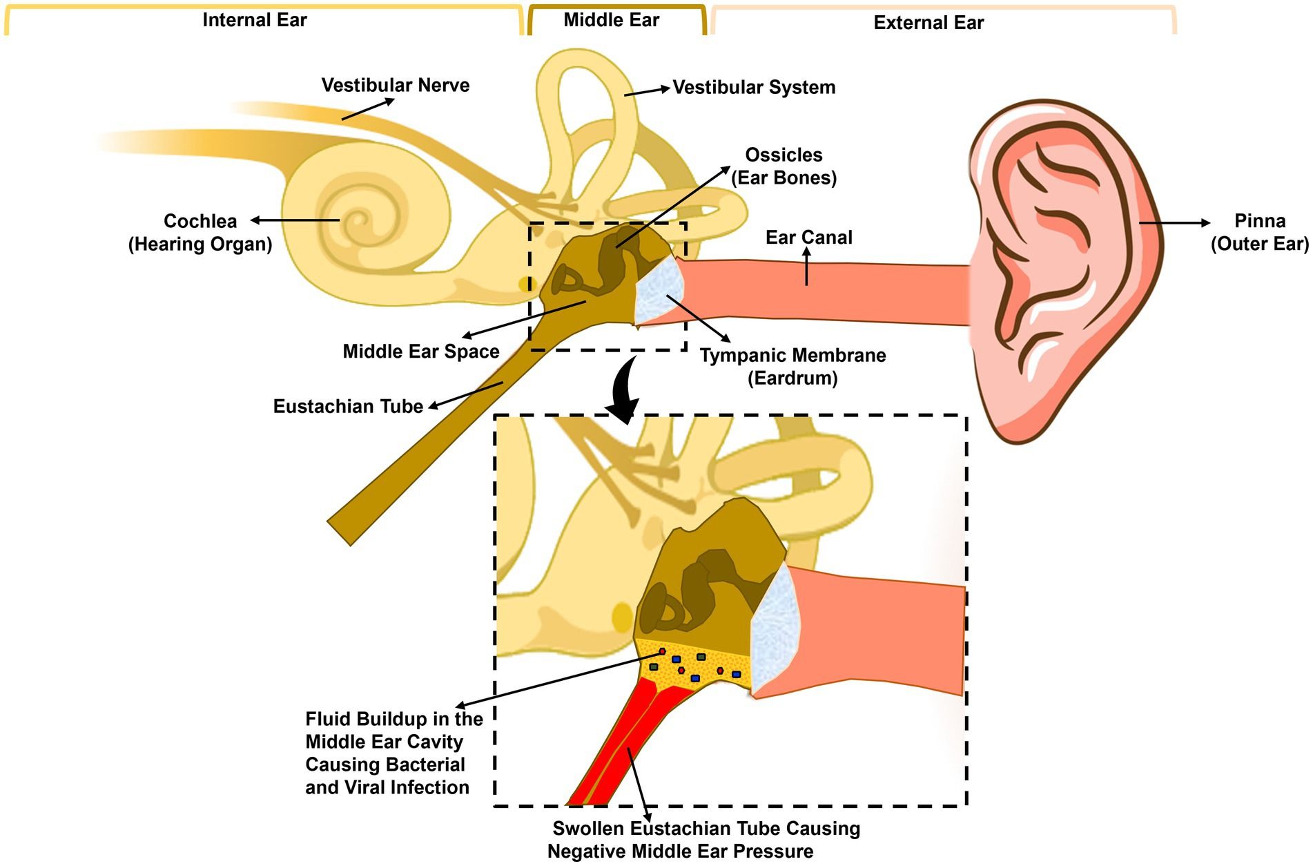 Diagram of the ear showing a swollen Eustachian tube, negative middle ear pressure and fluid collecting in the middle ear cavity