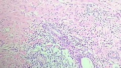 Prostate cancer evolution after COVID-19-related prostatitis in a TMPRSS2-altered patient: a case report and review of the molecular interface between SARS-CoV-2 and prostate oncogenesis