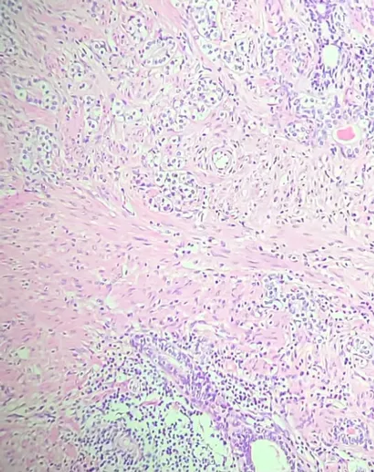 Prostate cancer evolution after COVID-19-related prostatitis in a TMPRSS2-altered patient: a case report and review of the molecular interface between SARS-CoV-2 and prostate oncogenesis
