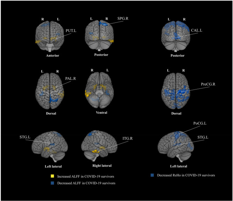 Brain abnormalities in survivors of COVID-19 after 2-year recovery: a functional MRI study