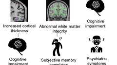 Structural brain changes in post-COVID condition and its relationship with cognitive impairment