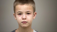 Pennsylvania tops 800 measles cases as CDC acknowledges only 1 measles death