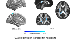 Patients recovering from COVID-19 who presented with anosmia during their acute episode have behavioral, functional, and structural brain alterations