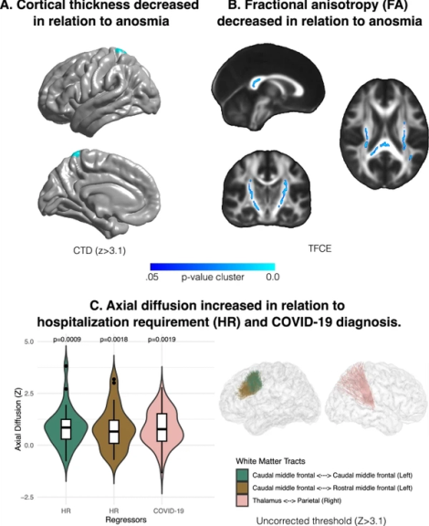 Patients recovering from COVID-19 who presented with anosmia during their acute episode have behavioral, functional, and structural brain alterations