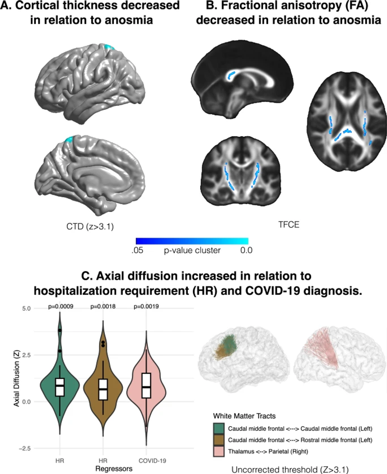 Patients recovering from COVID-19 who presented with anosmia during their acute episode have behavioral, functional, and structural brain alterations
