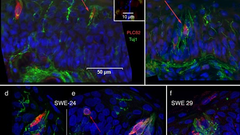 Taste dysfunction in long COVID