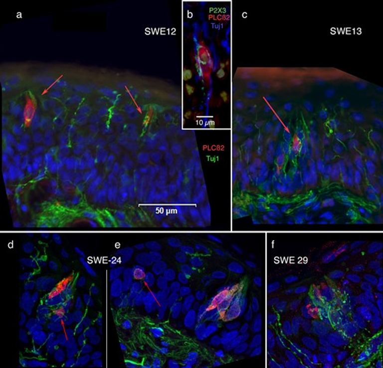 Taste dysfunction in long COVID